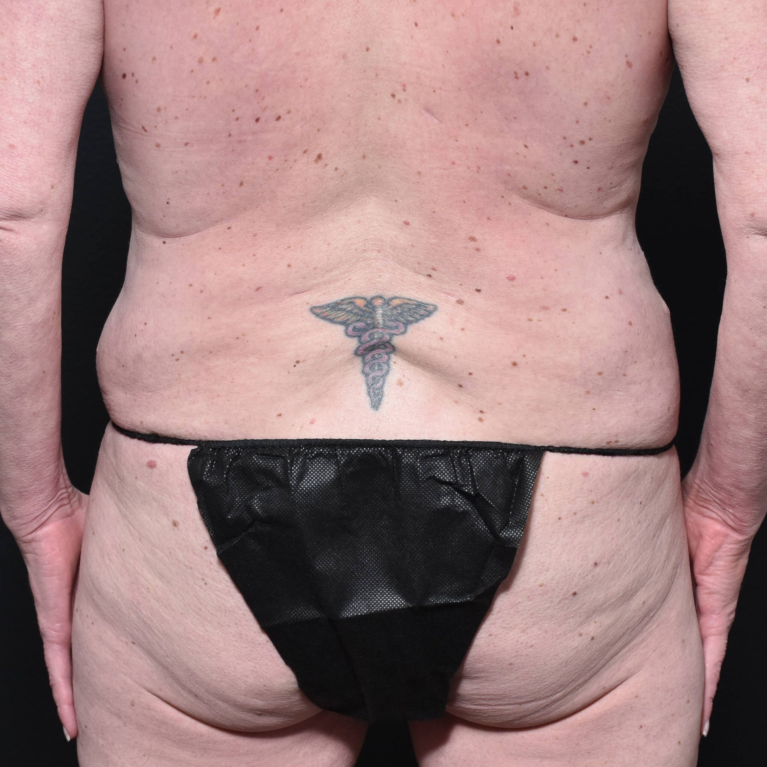 Case--5573 | Before Backplasty