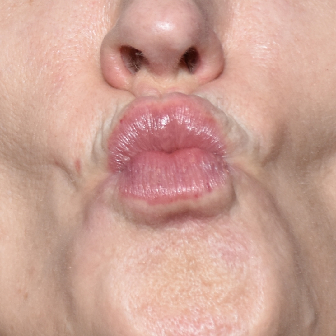 Case--7970 | Before Facial Fillers 1