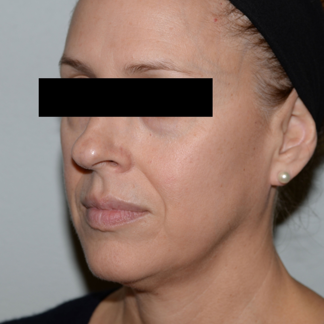 Case--2377 | Before Facial Fillers 1