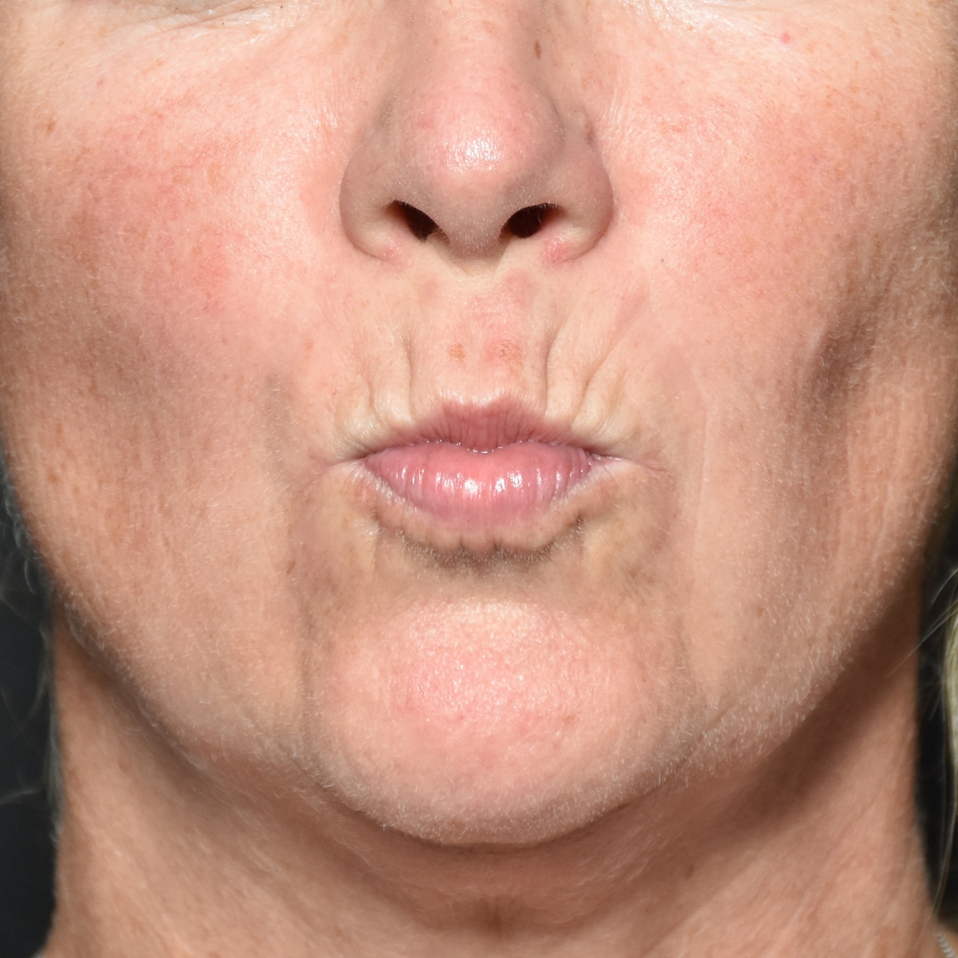 Case--4342 | Before Facial Fillers 1