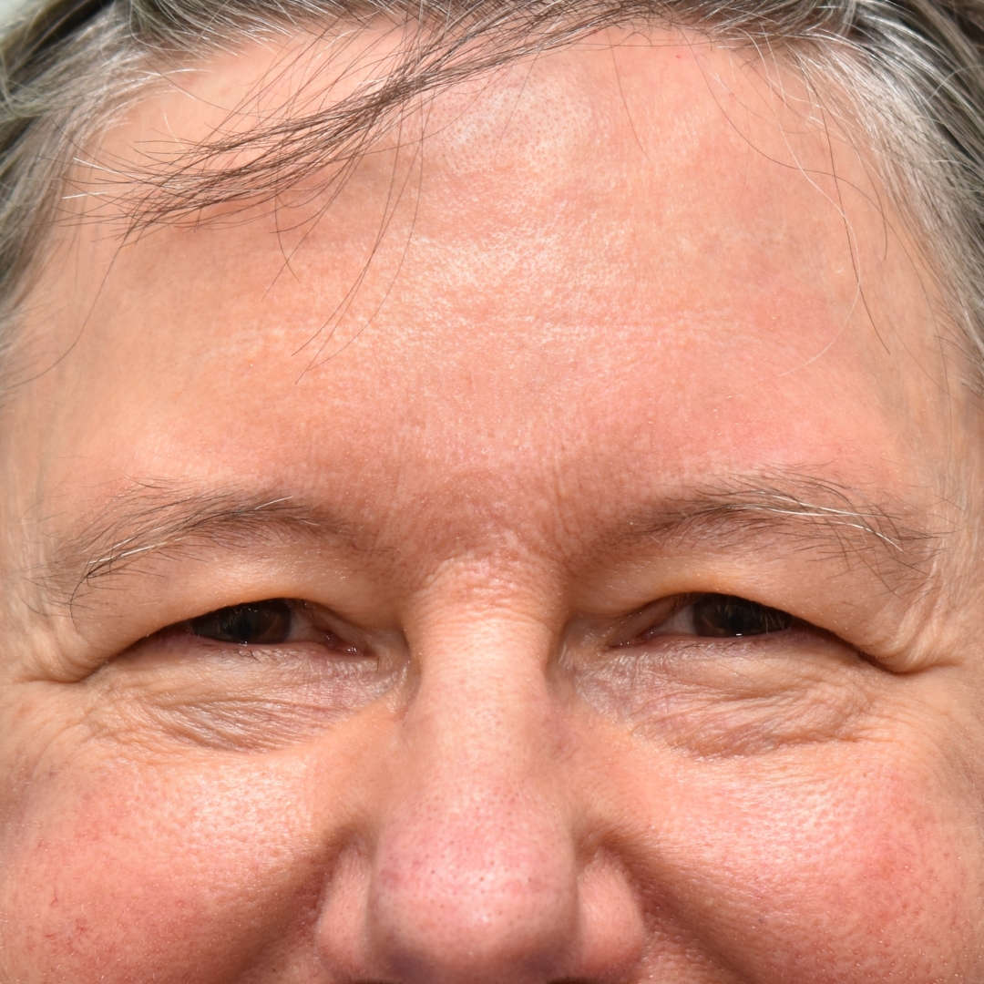 Case--5356 | Before Upper Blepharoplasty
