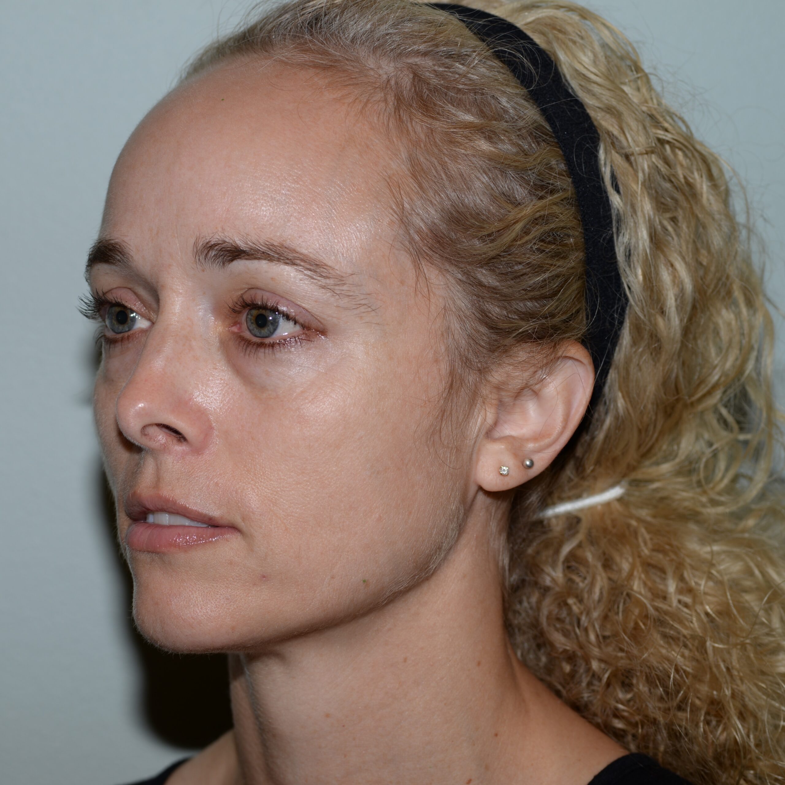 Case--2131 | After IPL & Laser Treatments 2