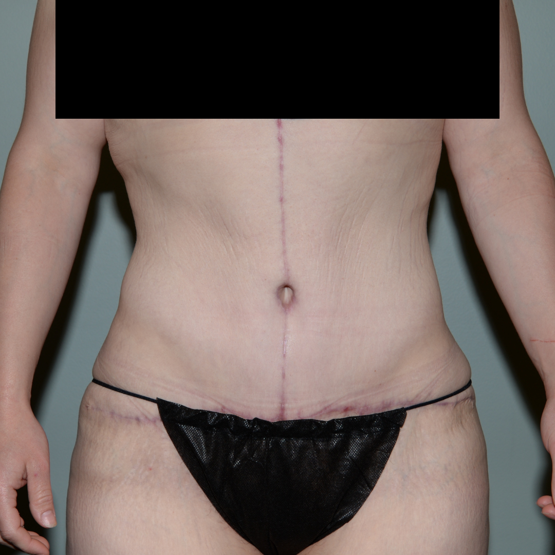 Case--5386 | After Massive Weight Loss