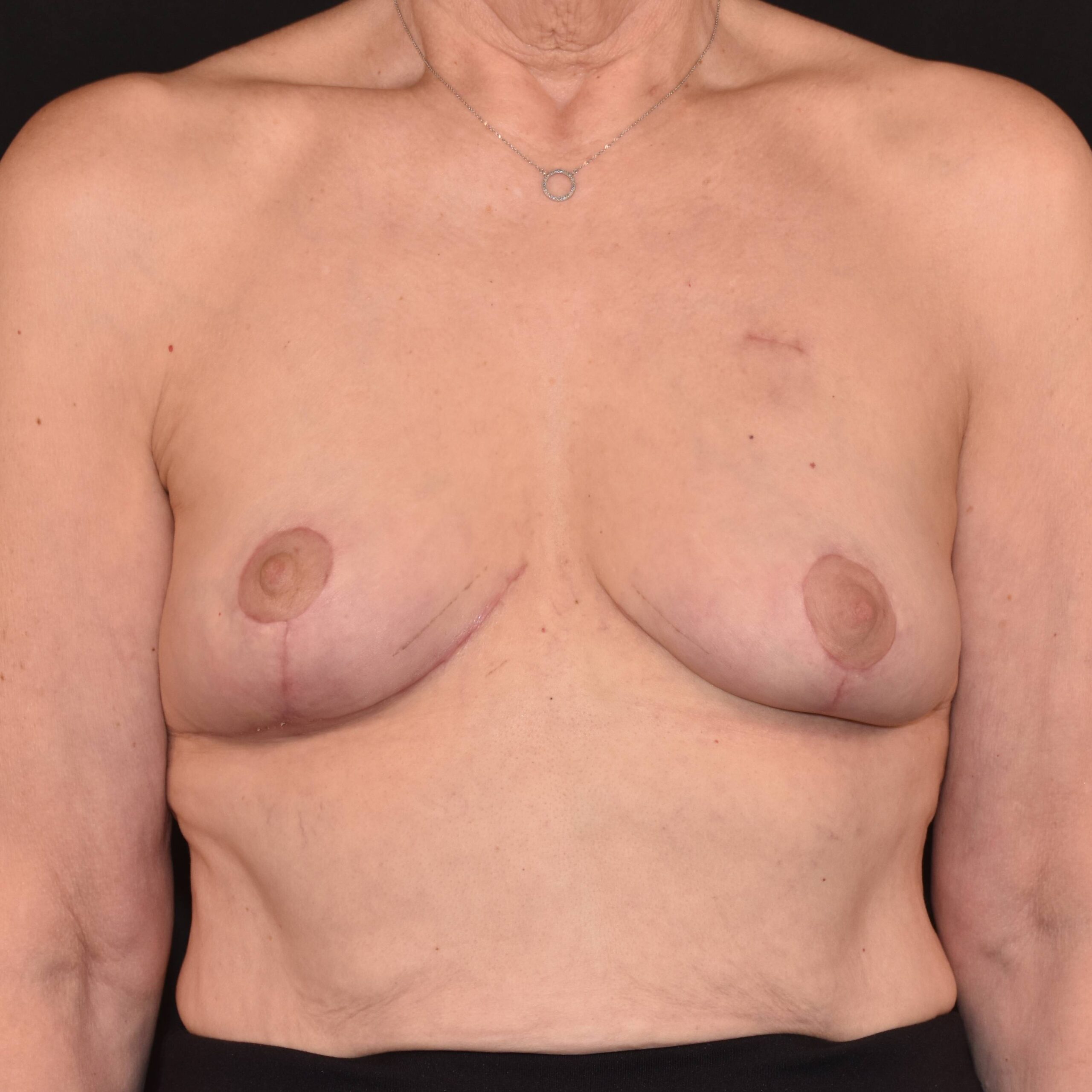 Case--4923 | After Breast Reconstruction