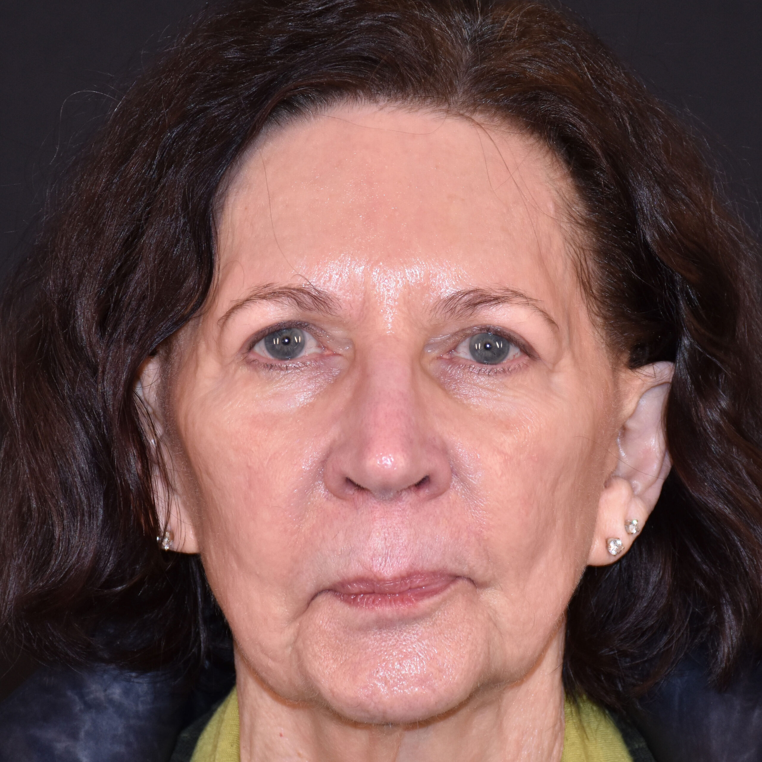 Case--1382 | After Facial Fillers