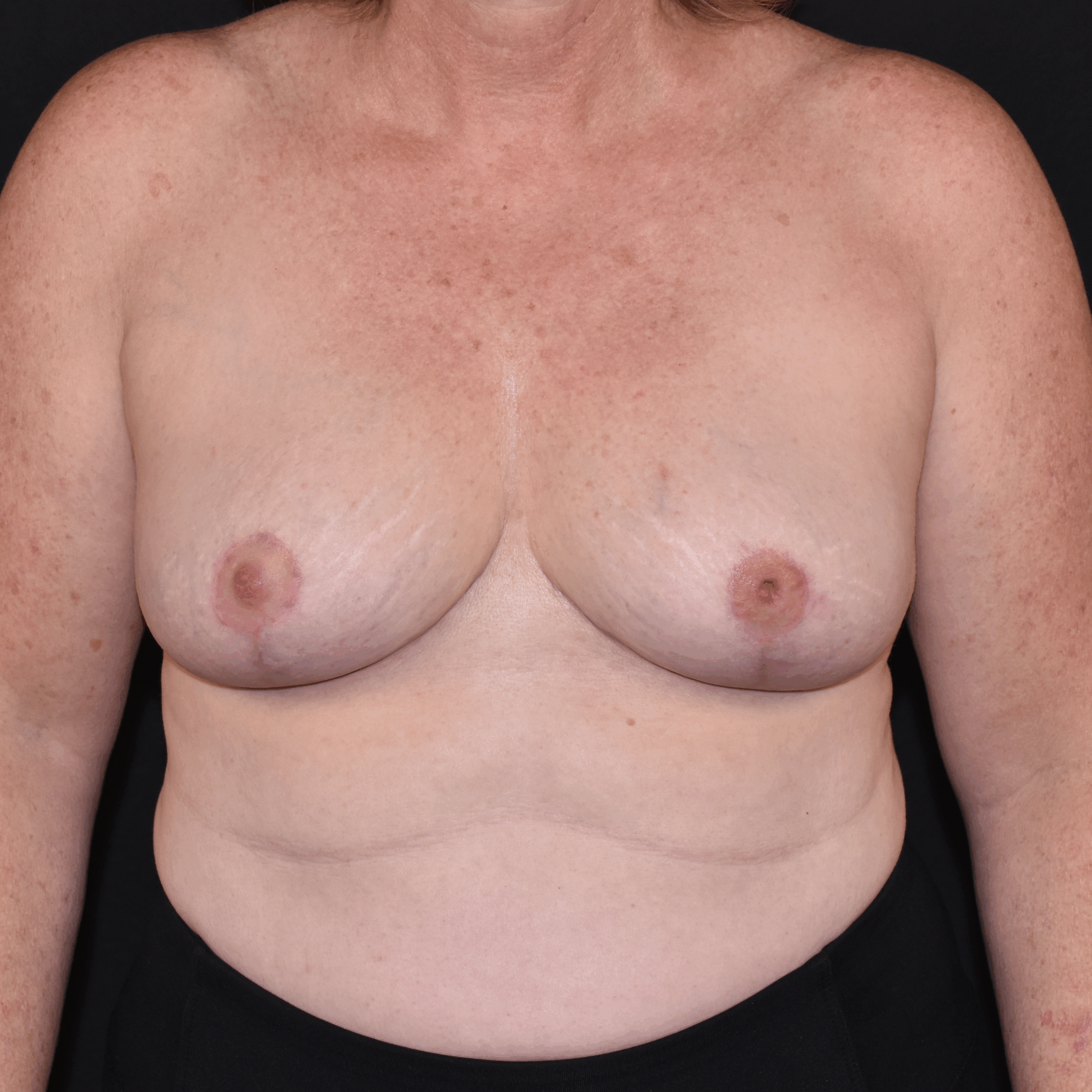 Case--5625 | After Breast Reduction