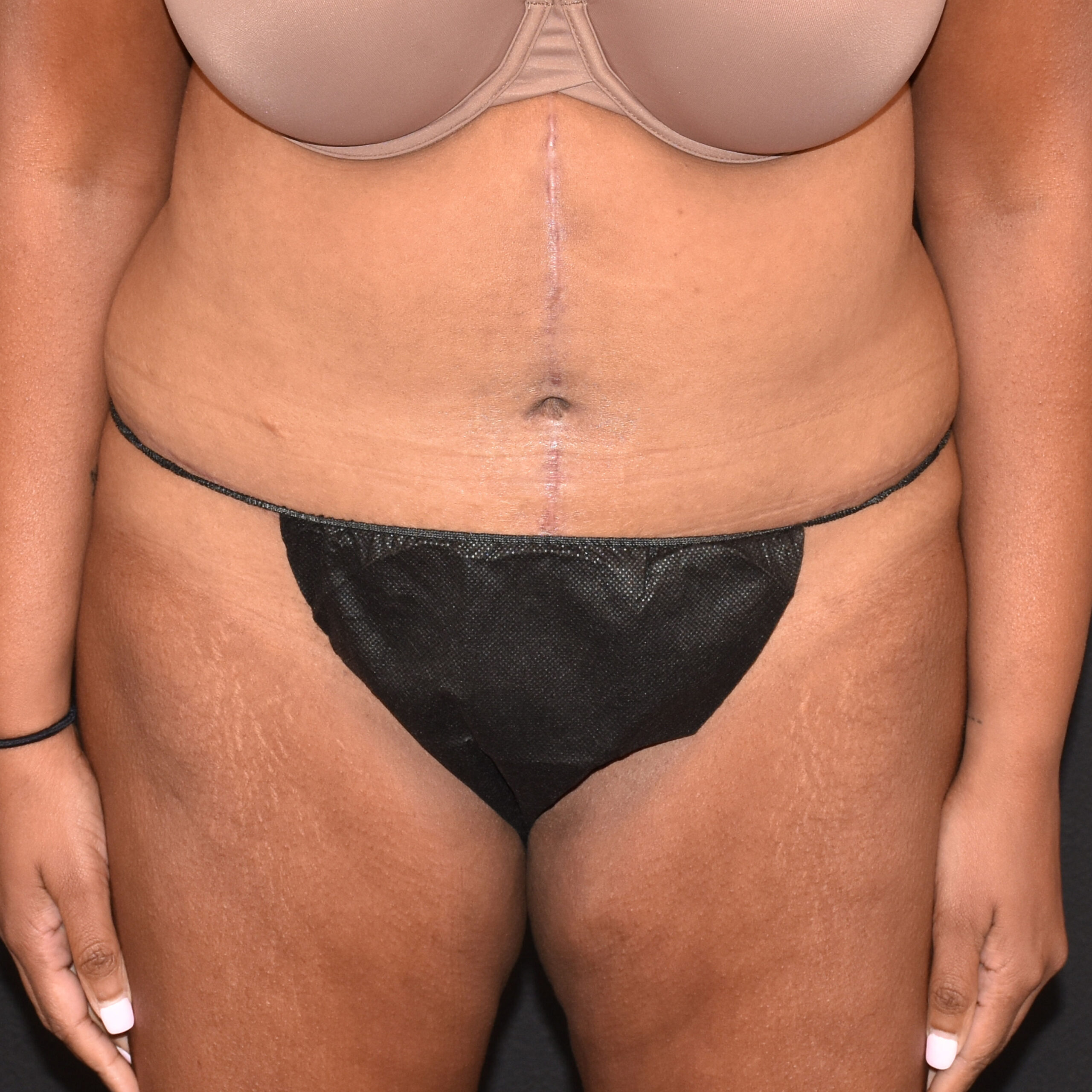 Case--8957 | After Tummy Tuck