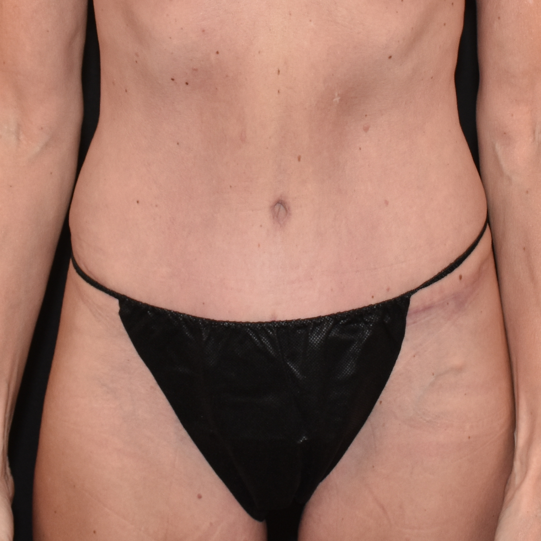 Case--4933 | After Tummy Tuck 1