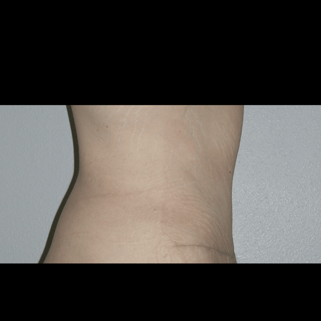 Case--60760 | After Massive Weight Loss 2