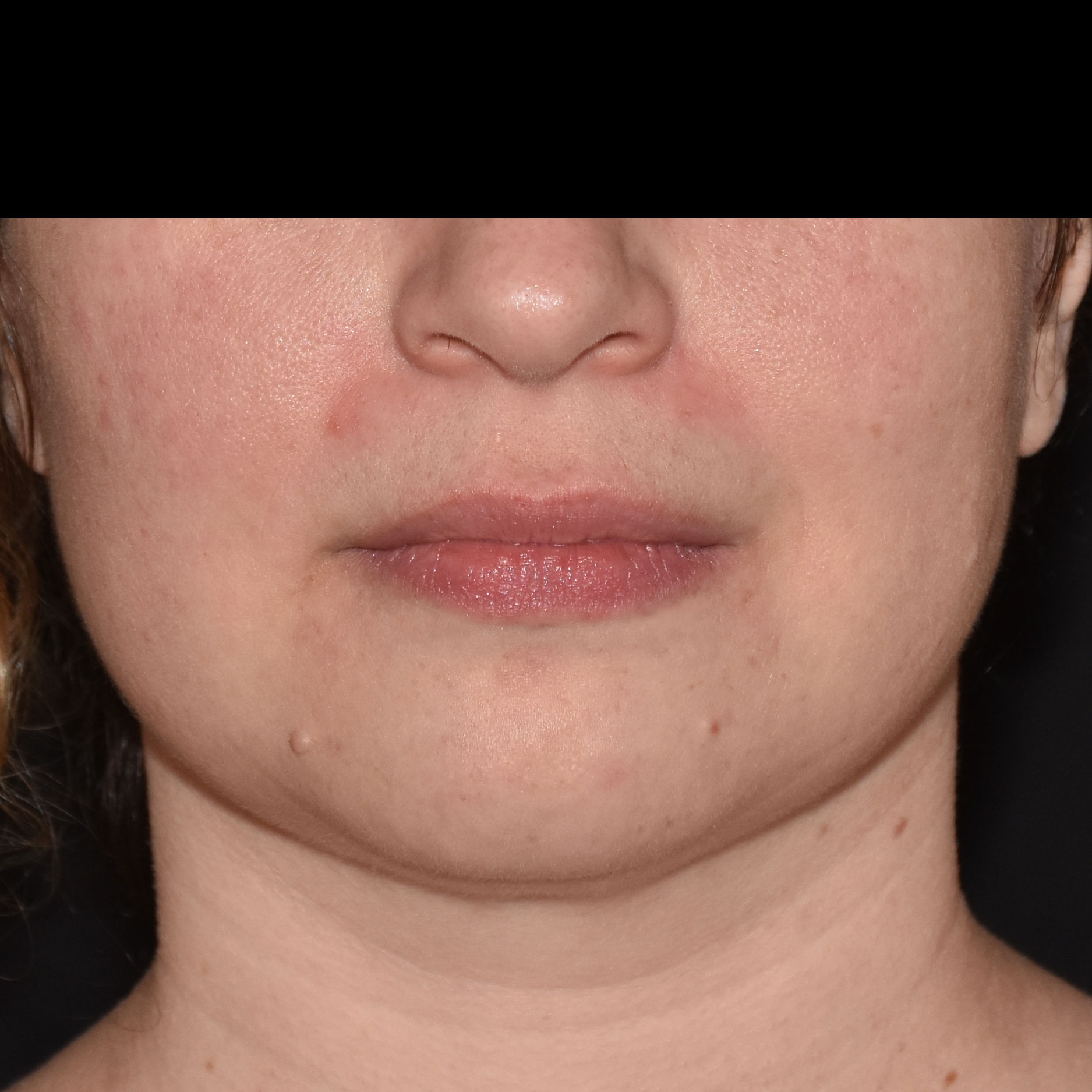 Case--8379 | After Face Treatments
