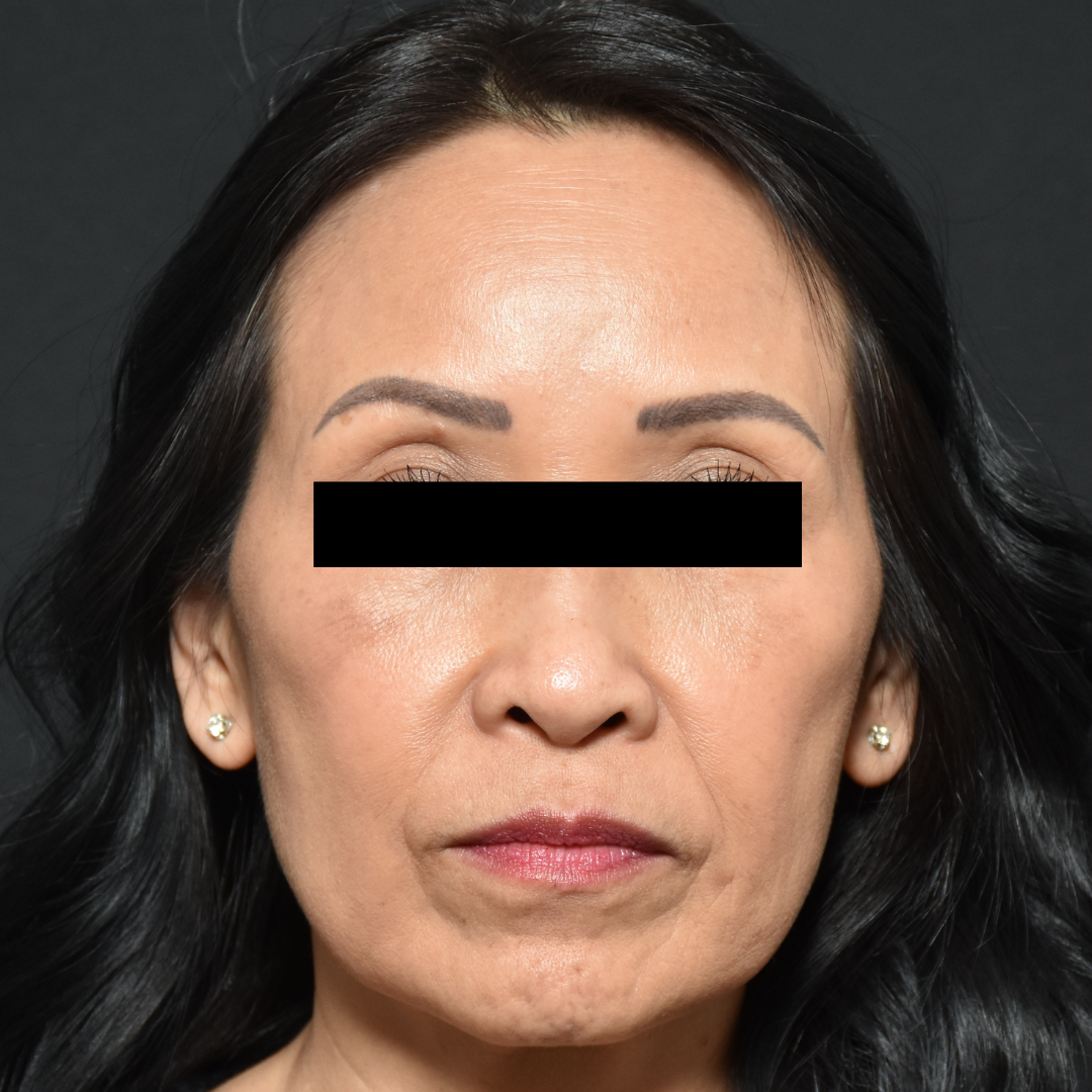 Case--7237 | After Microneedling (Face)