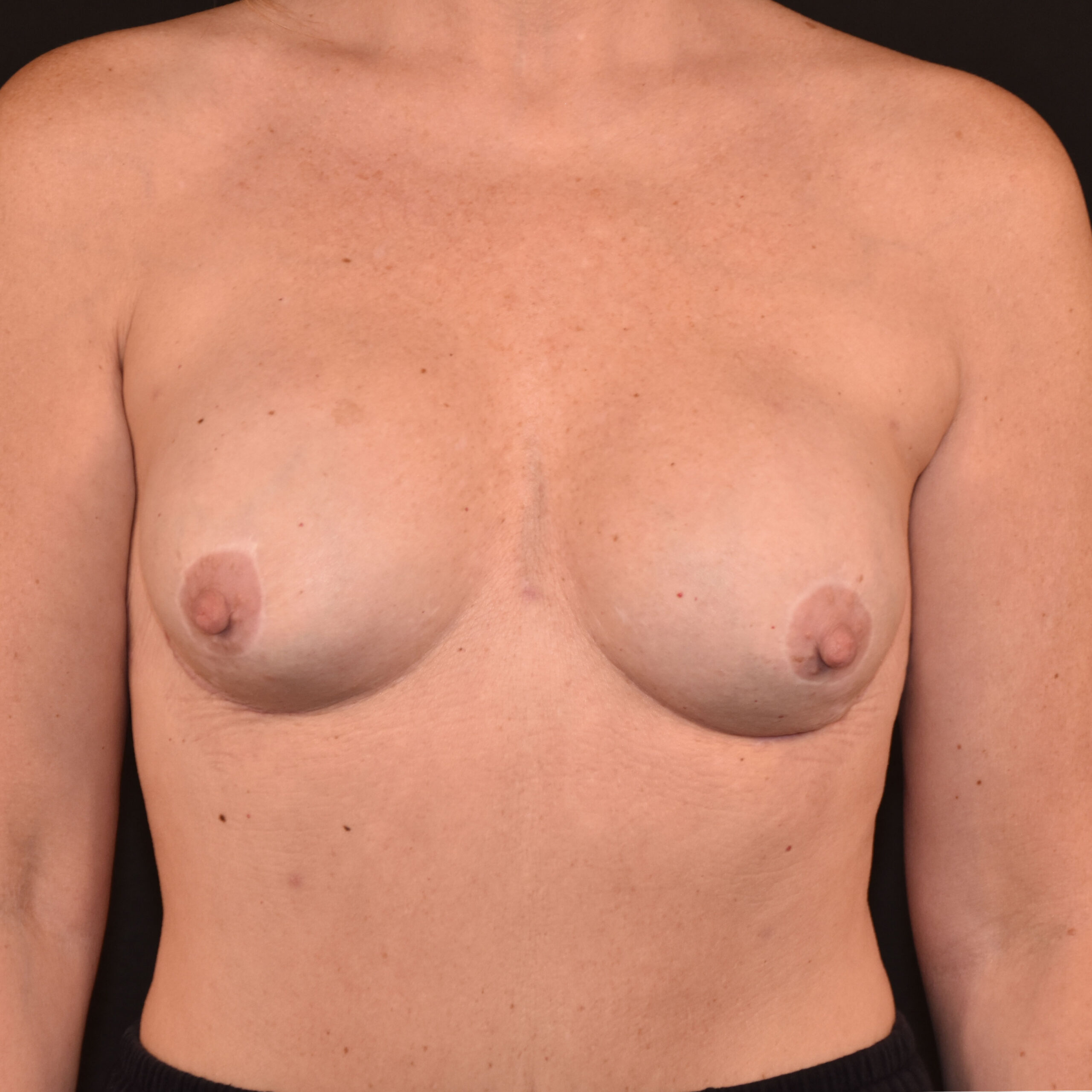 Case--2352 | After Breast Reconstruction