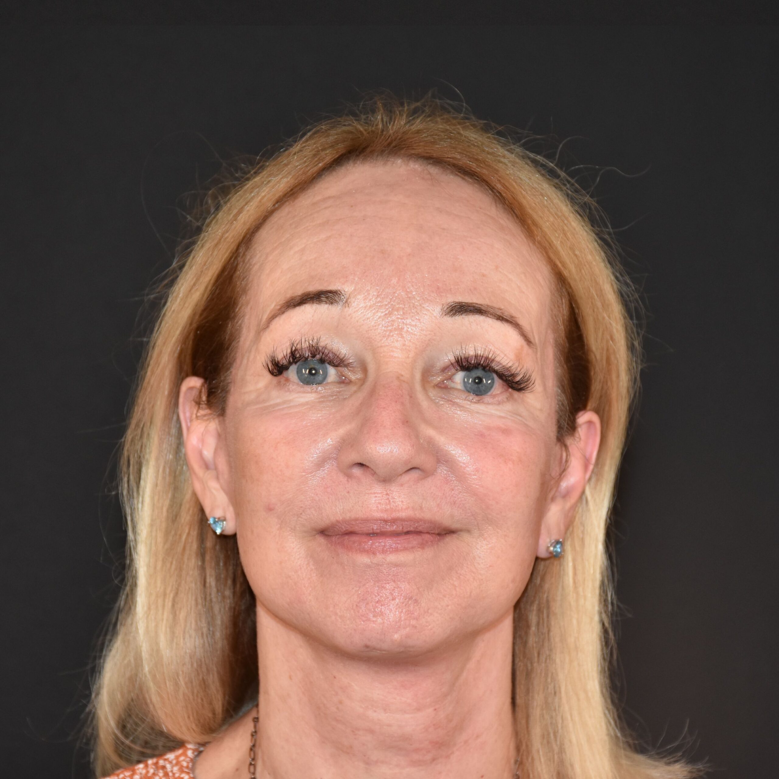 Case--3488 | After Upper Blepharoplasty