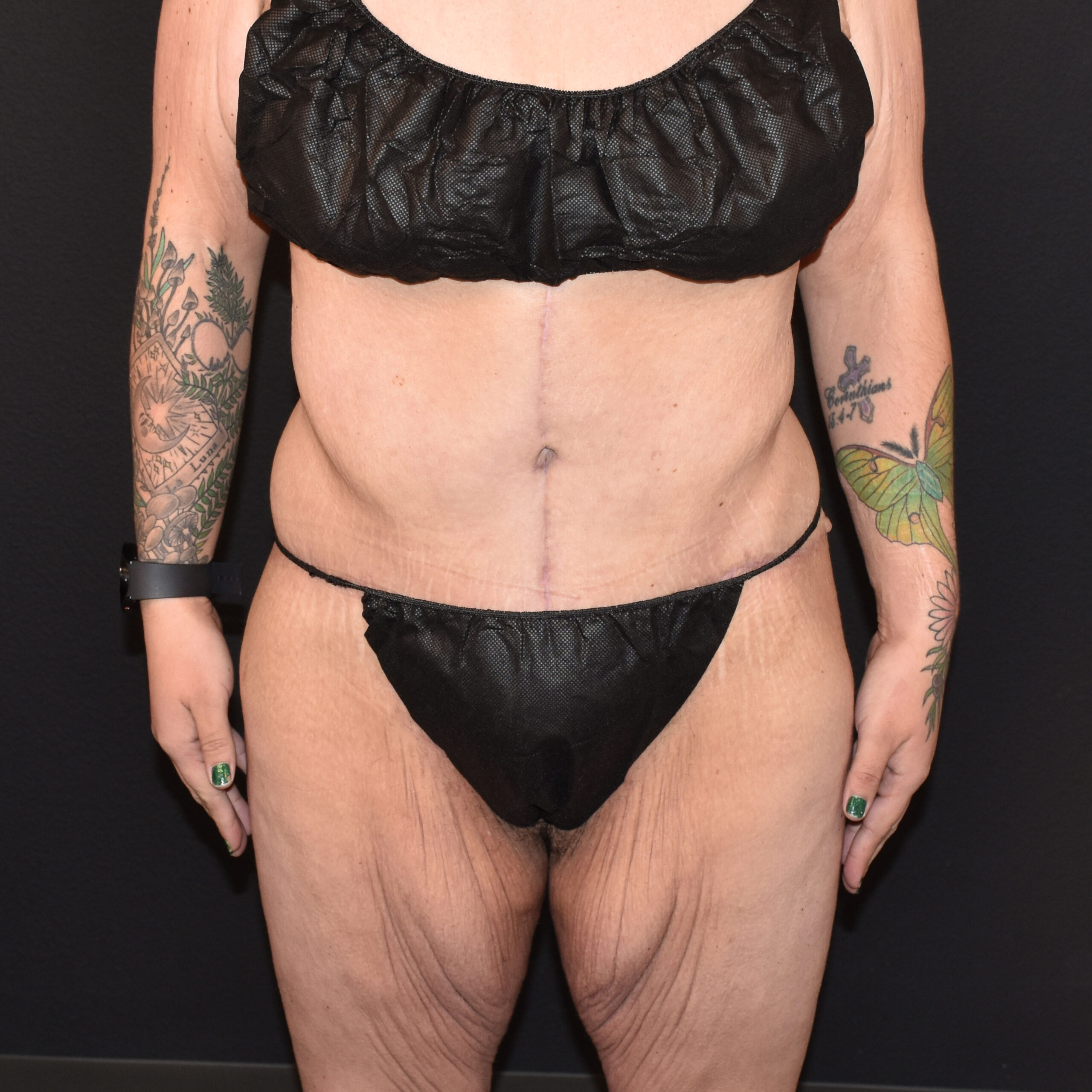 Case--8152 | After Massive Weight Loss