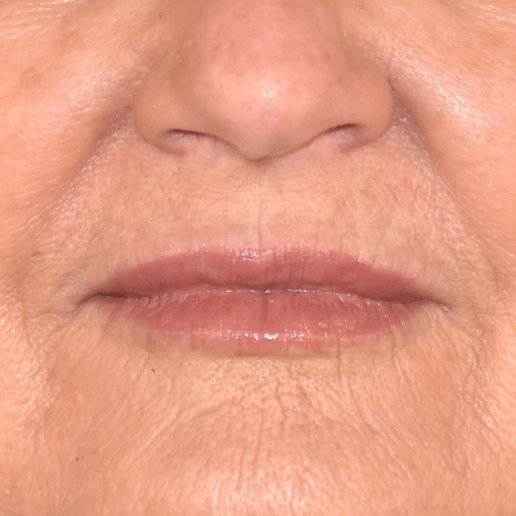 Case--4199 | After Facial Fillers