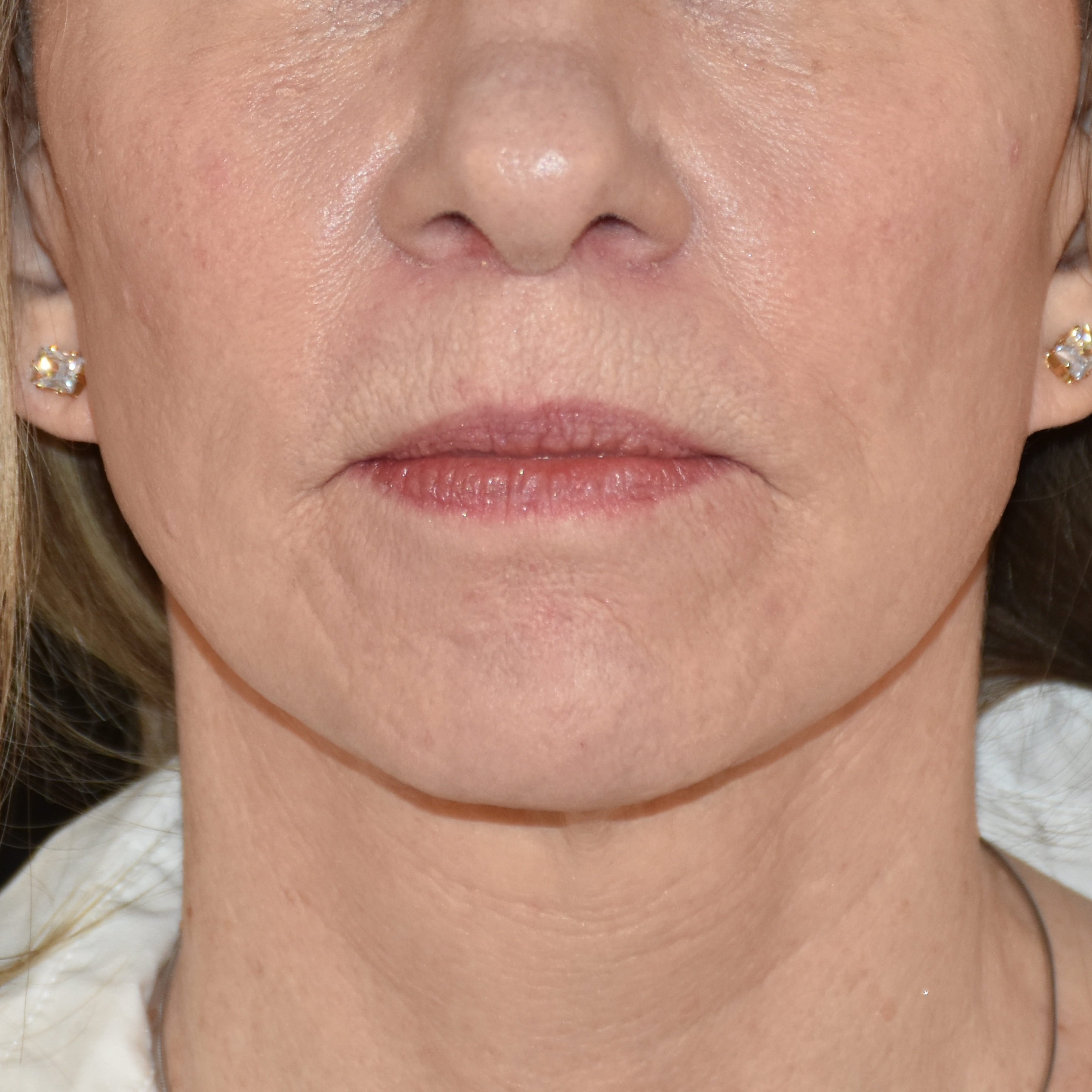 Case--5516 | After Lip Lift