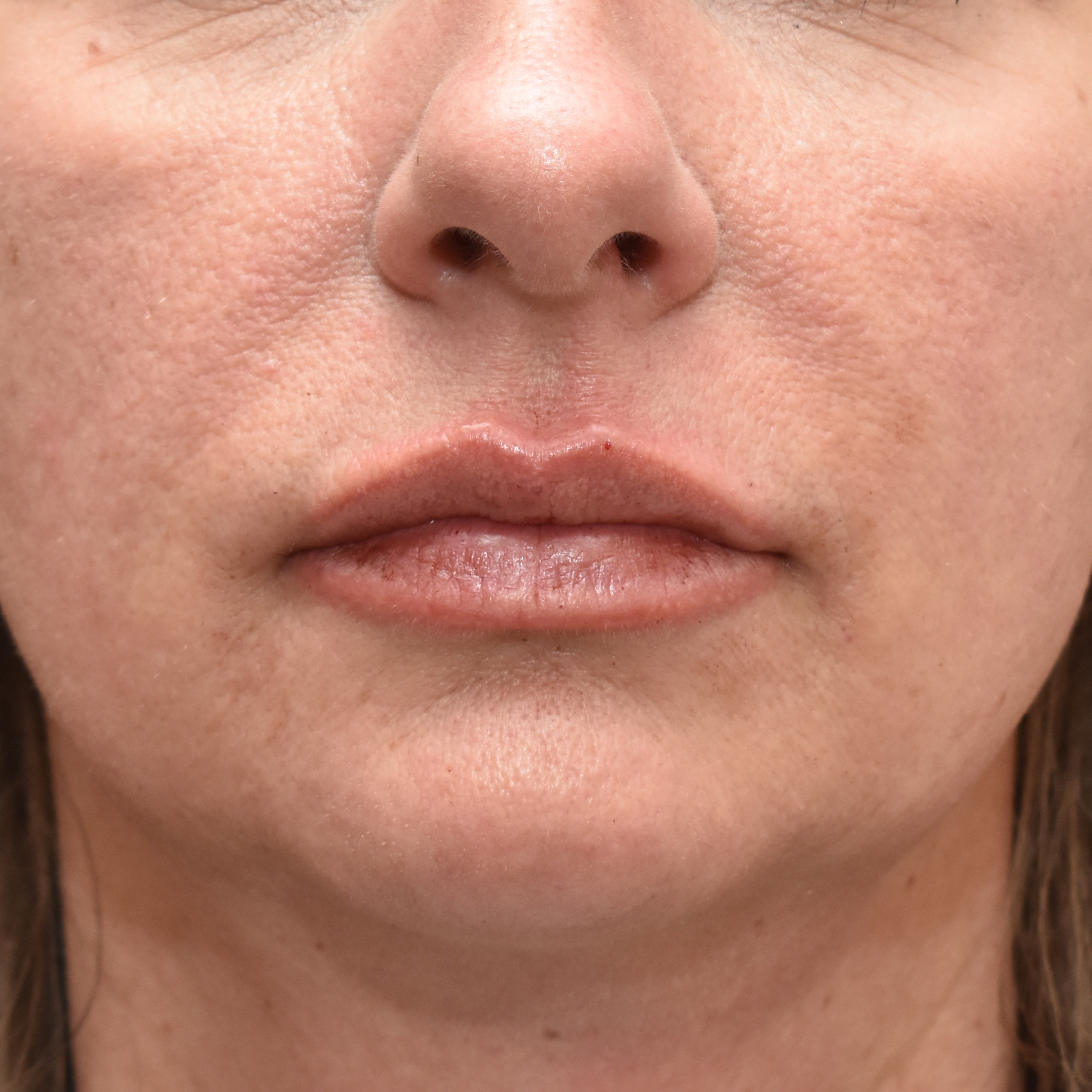 Case--4475 | After Facial Fillers