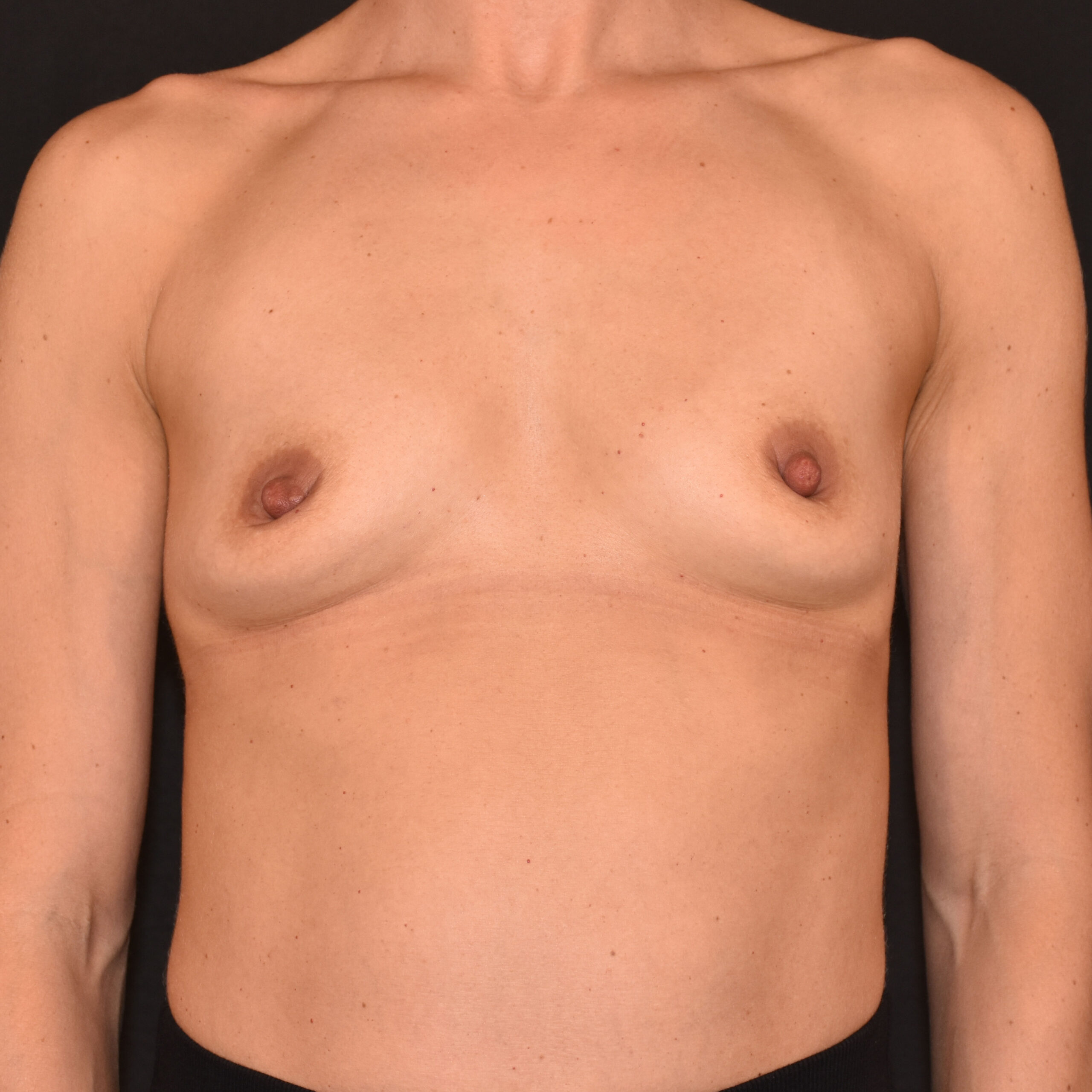 Case--3340 | Before Breast Augmentation