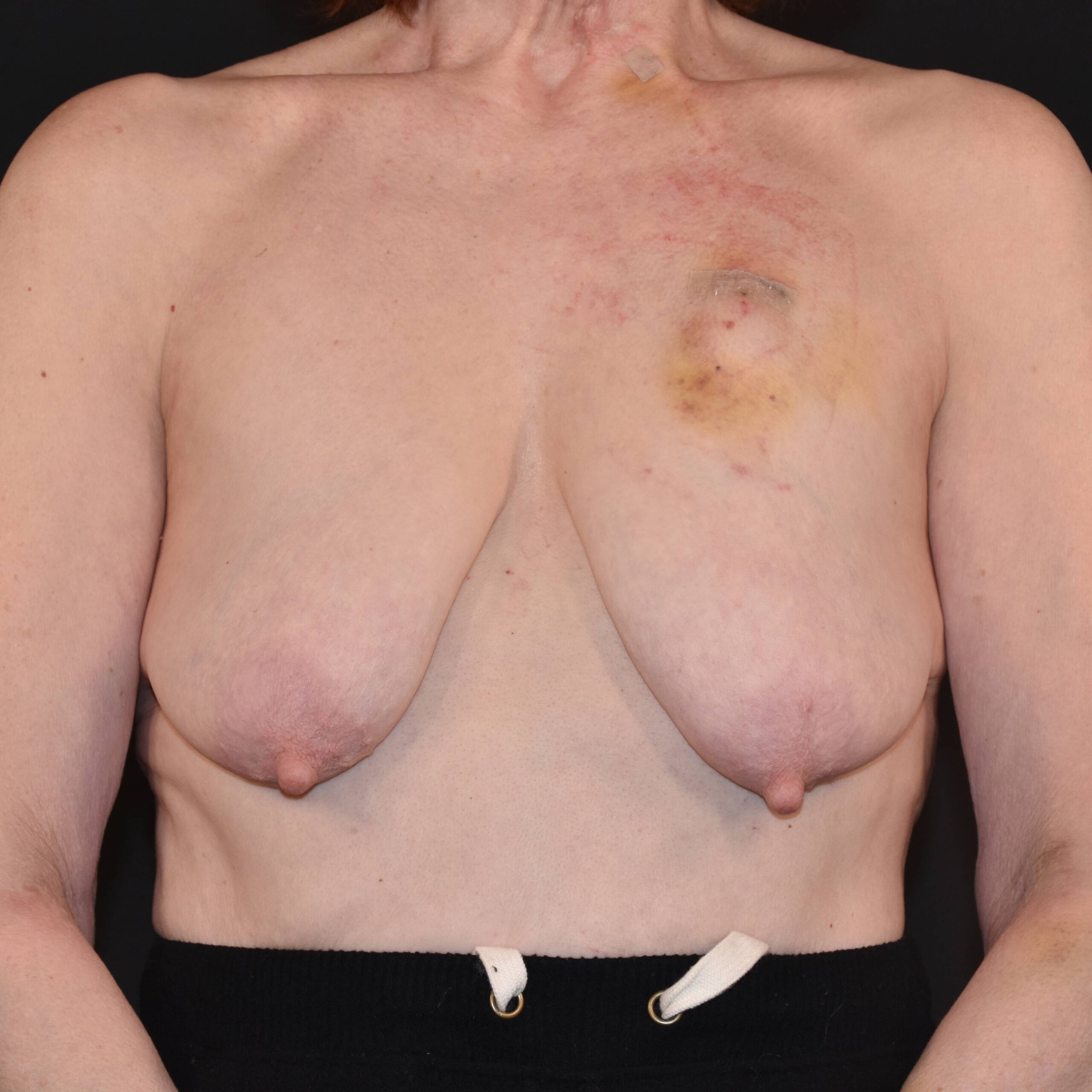 Case--4923 | Before Breast Reconstruction