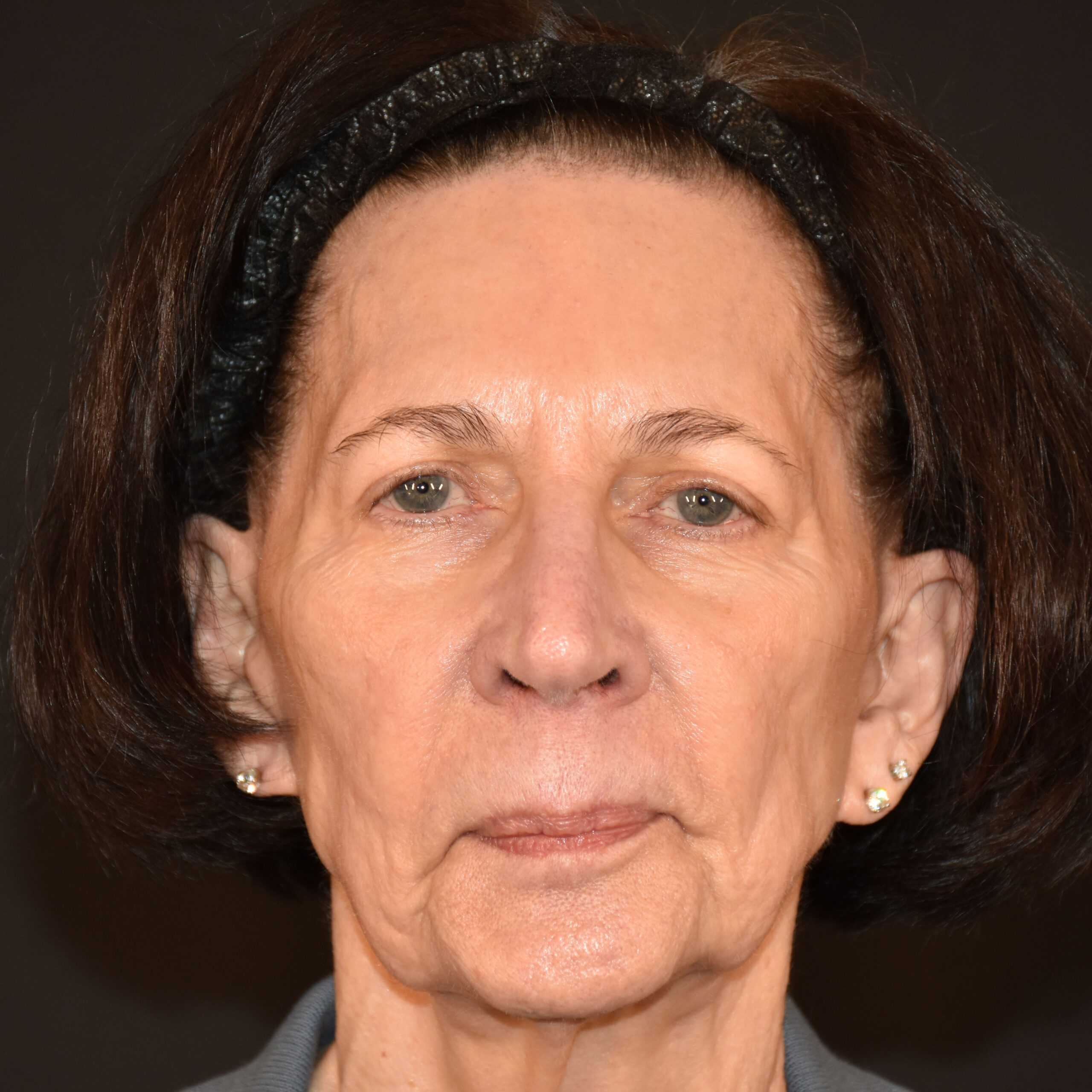 Case--1382 | Before Facial Fillers