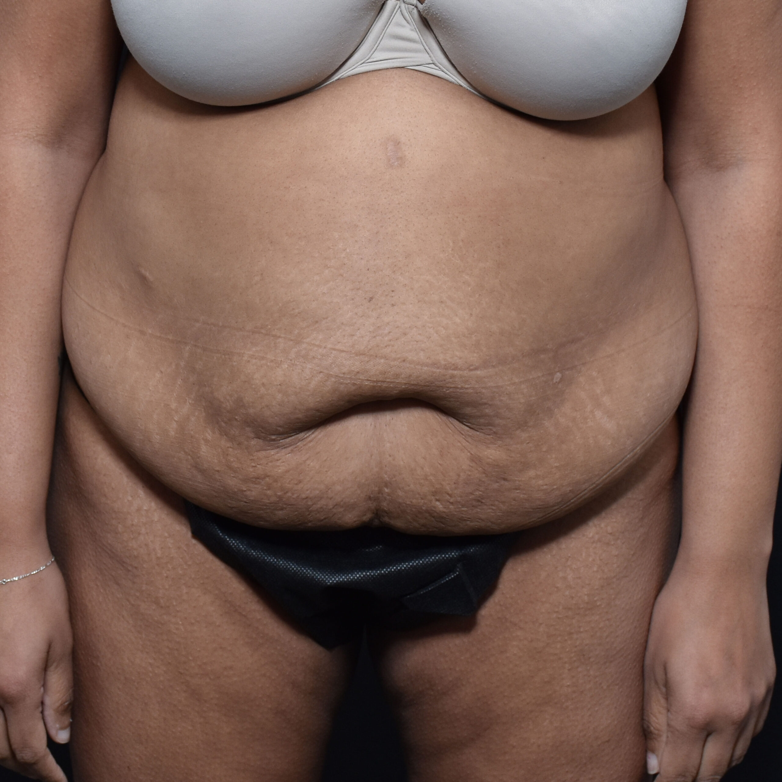 Case--8957 | Before Tummy Tuck