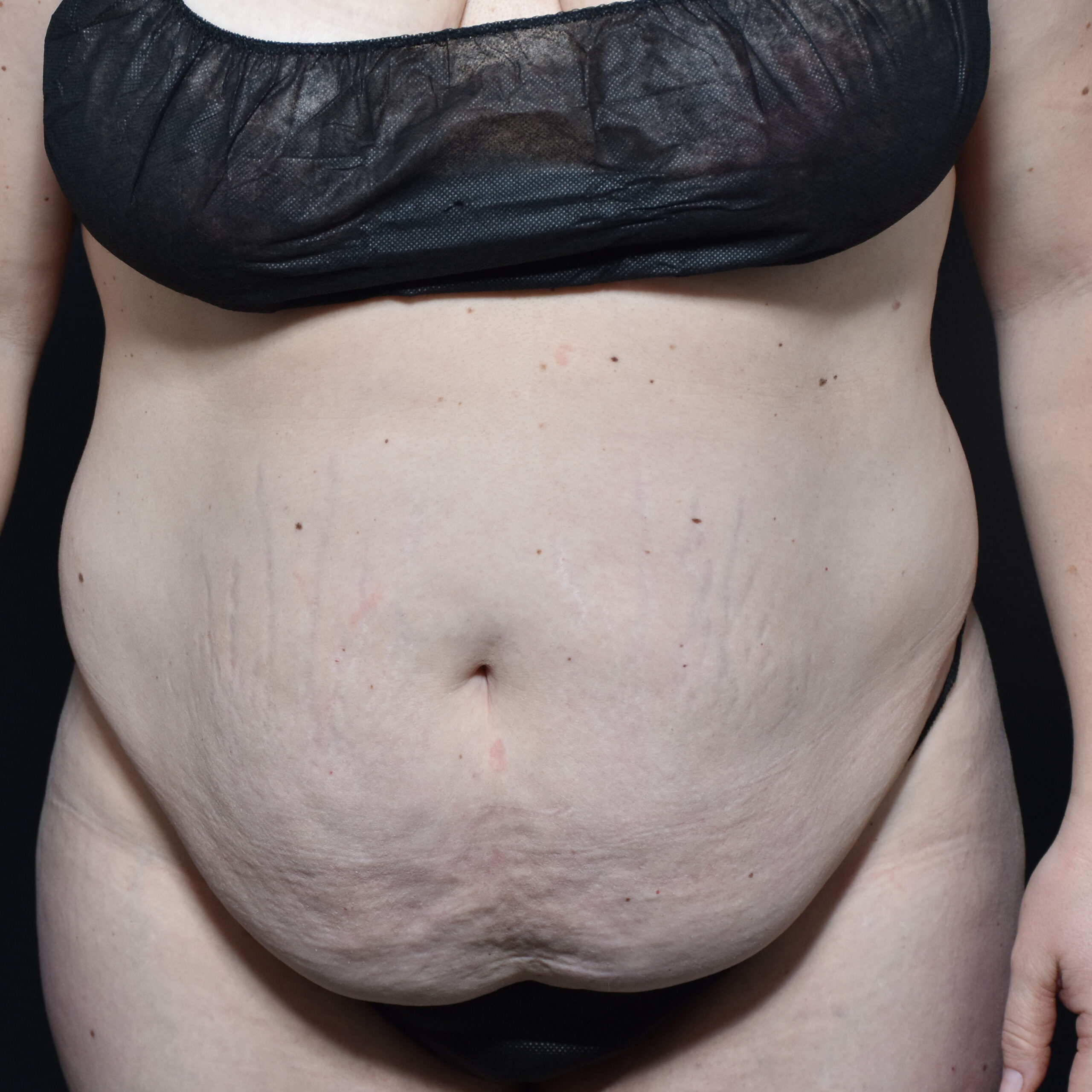 Case--2409 | Before Tummy Tuck