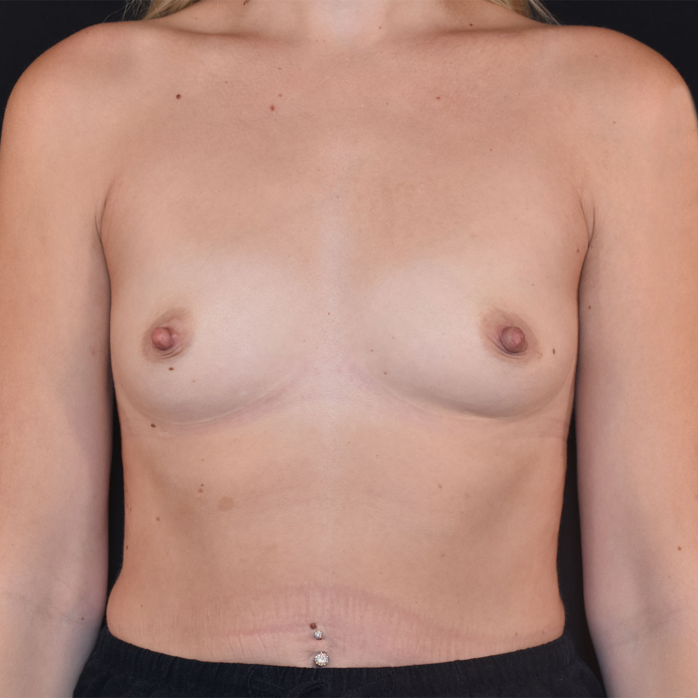 Case--4036 | Before Breast