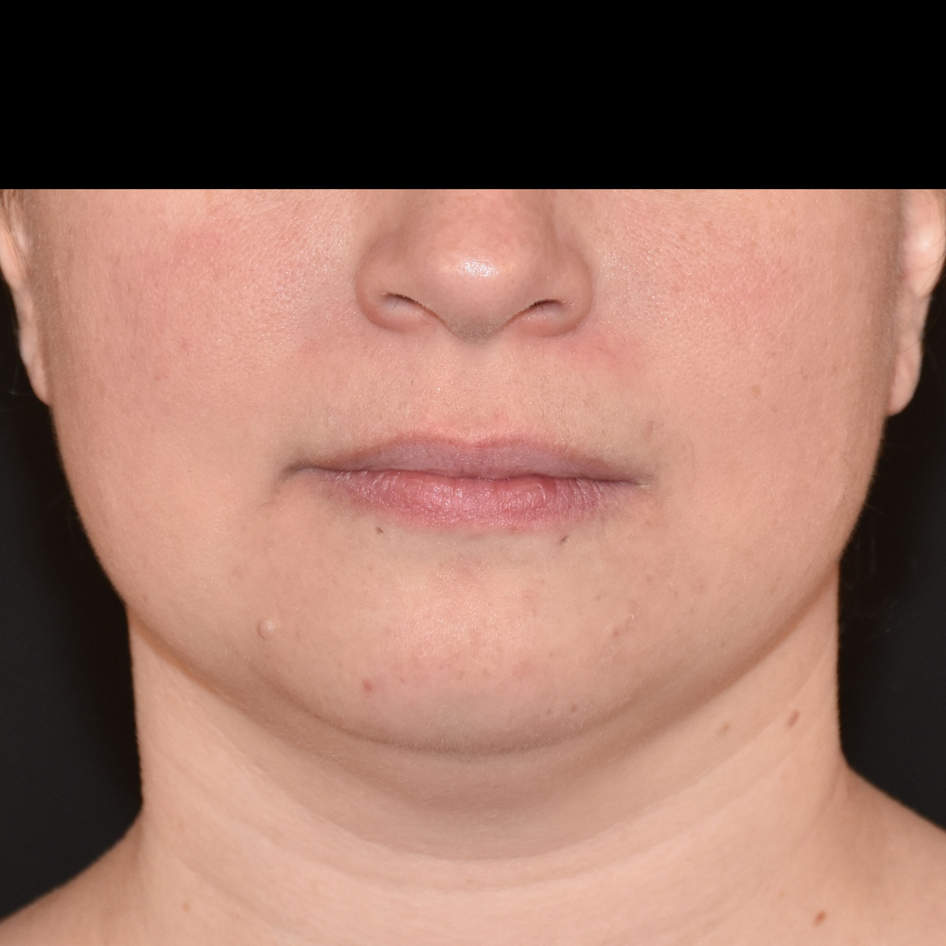 Case--8379 | Before Face Treatments