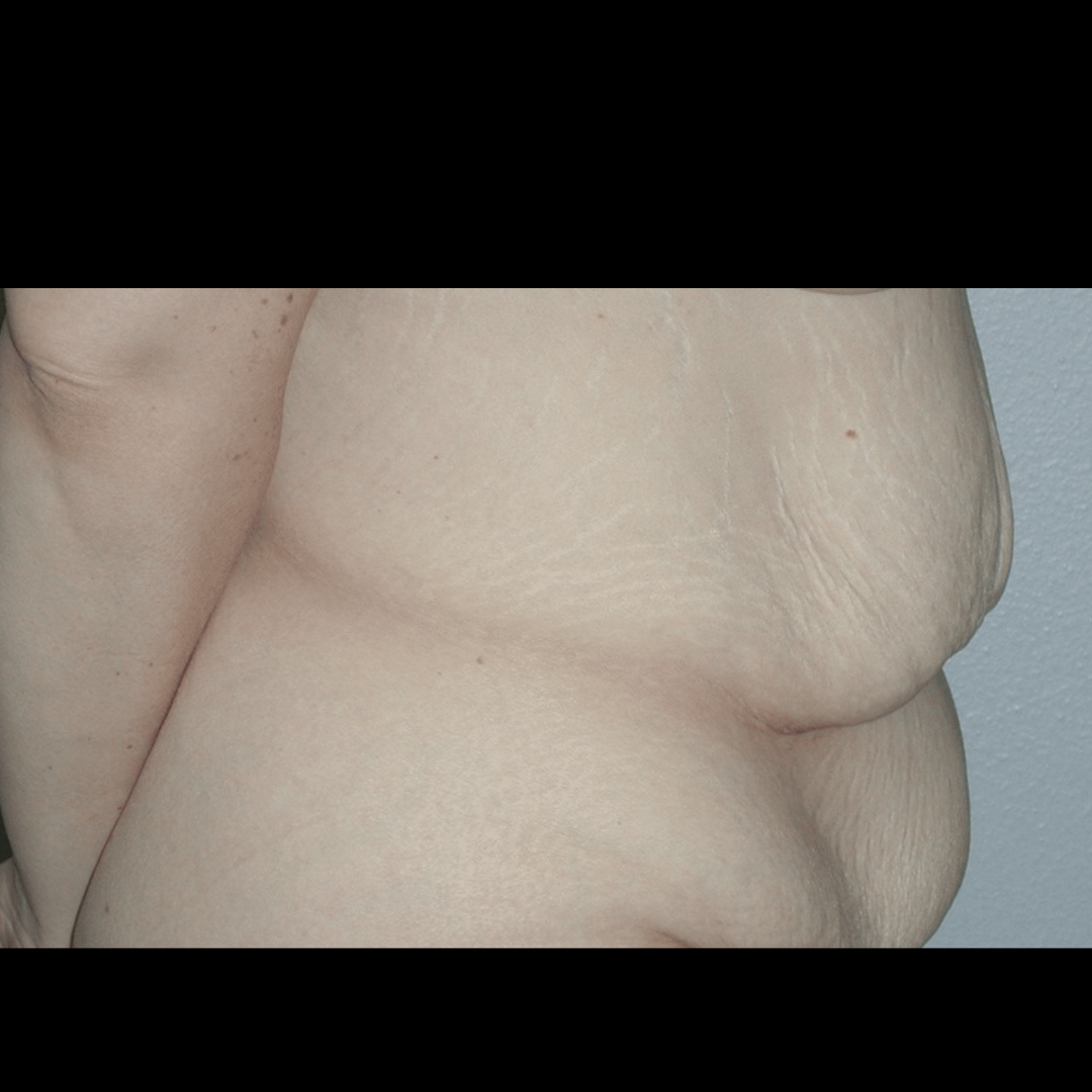 Case--60760 | Before Massive Weight Loss 2