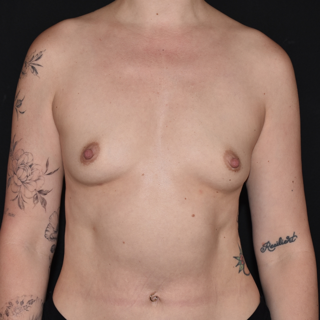 Case--5001 | Before Breast Augmentation