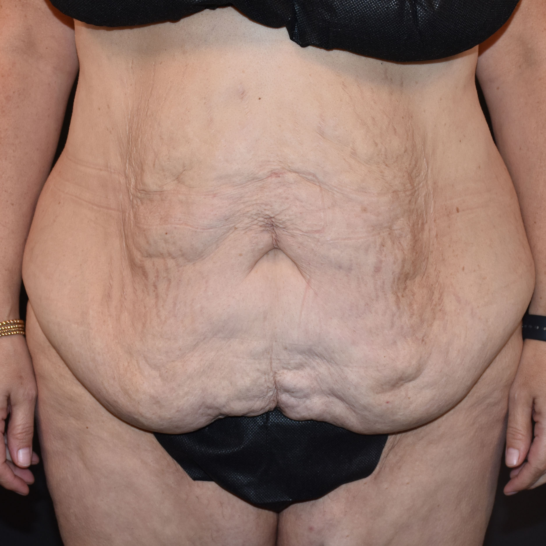 Case--2416 | Before Tummy Tuck