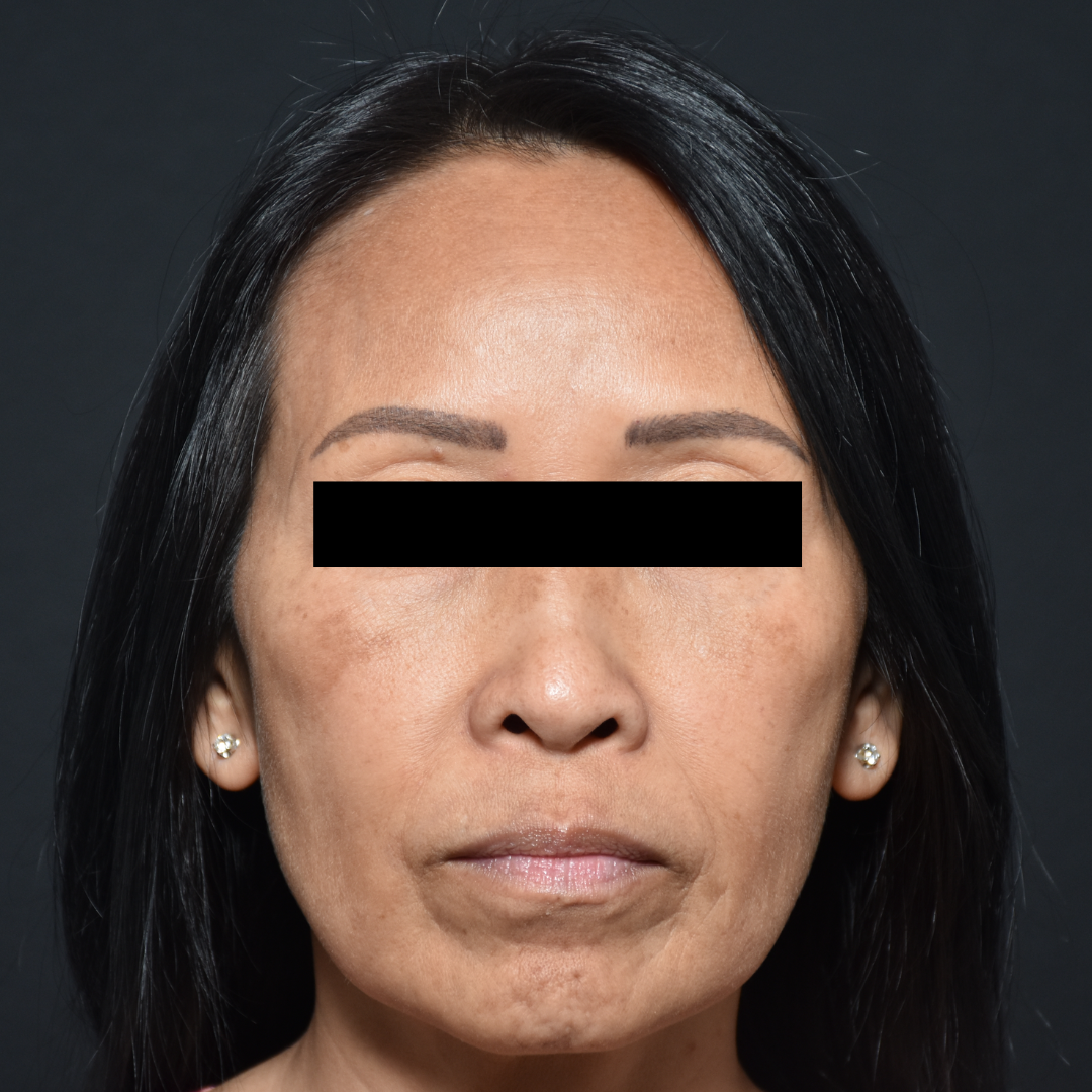 Case--7237 | Before Microneedling (Face)
