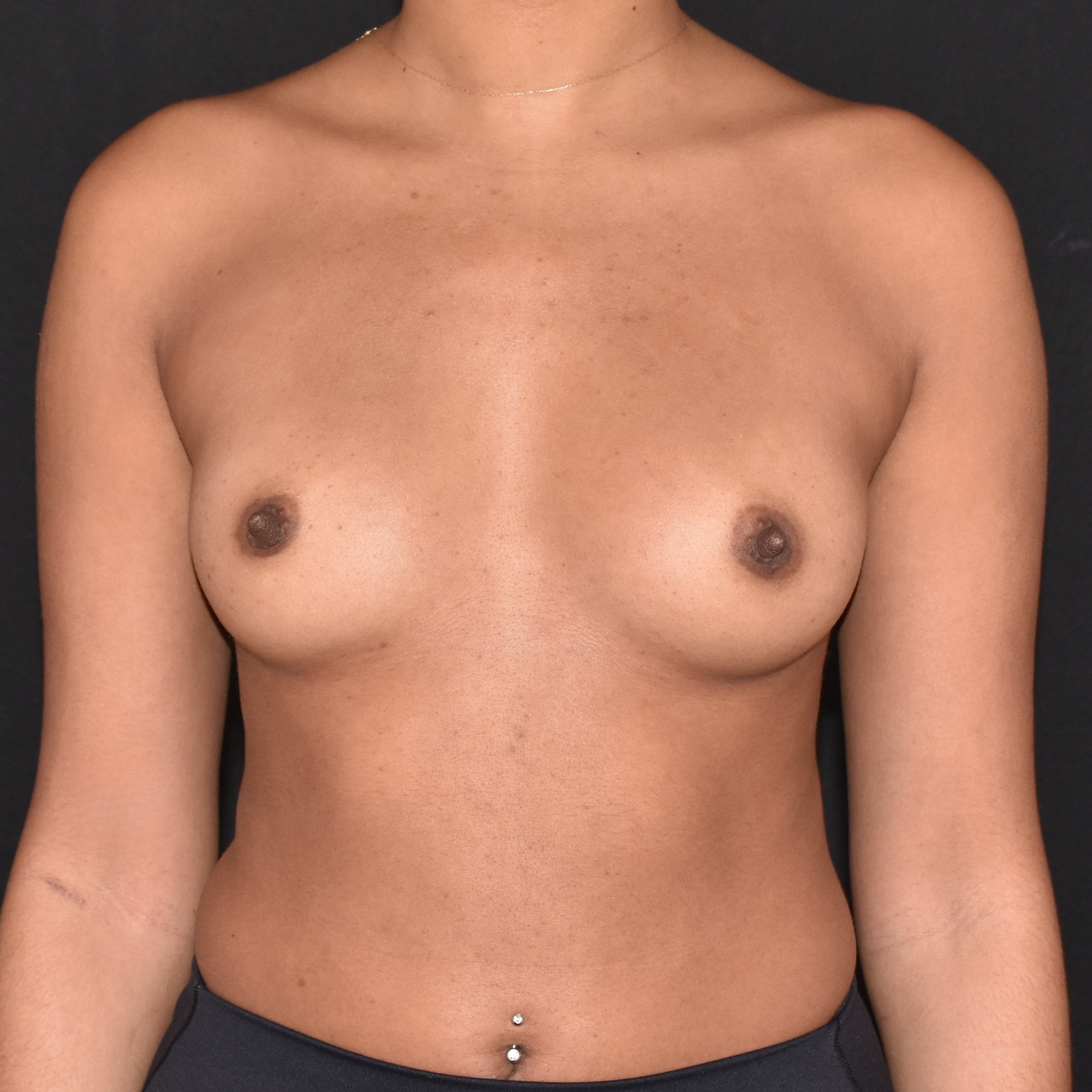 Case--8909 | Before Breast Augmentation