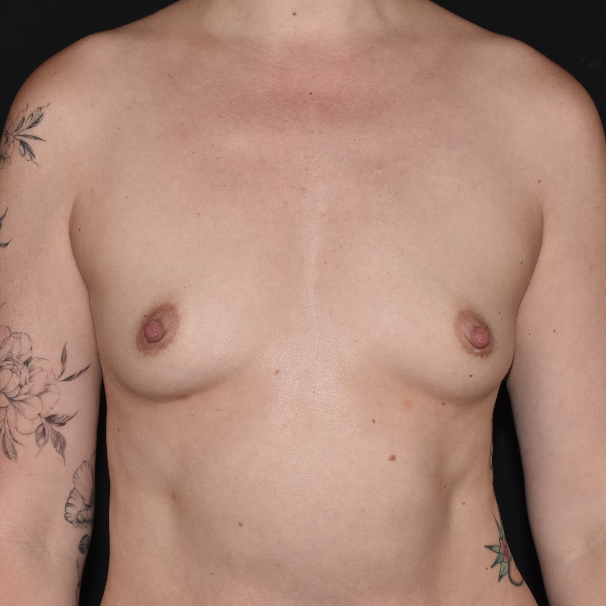 Case--5001 | Before Breast Augmentation Preservé