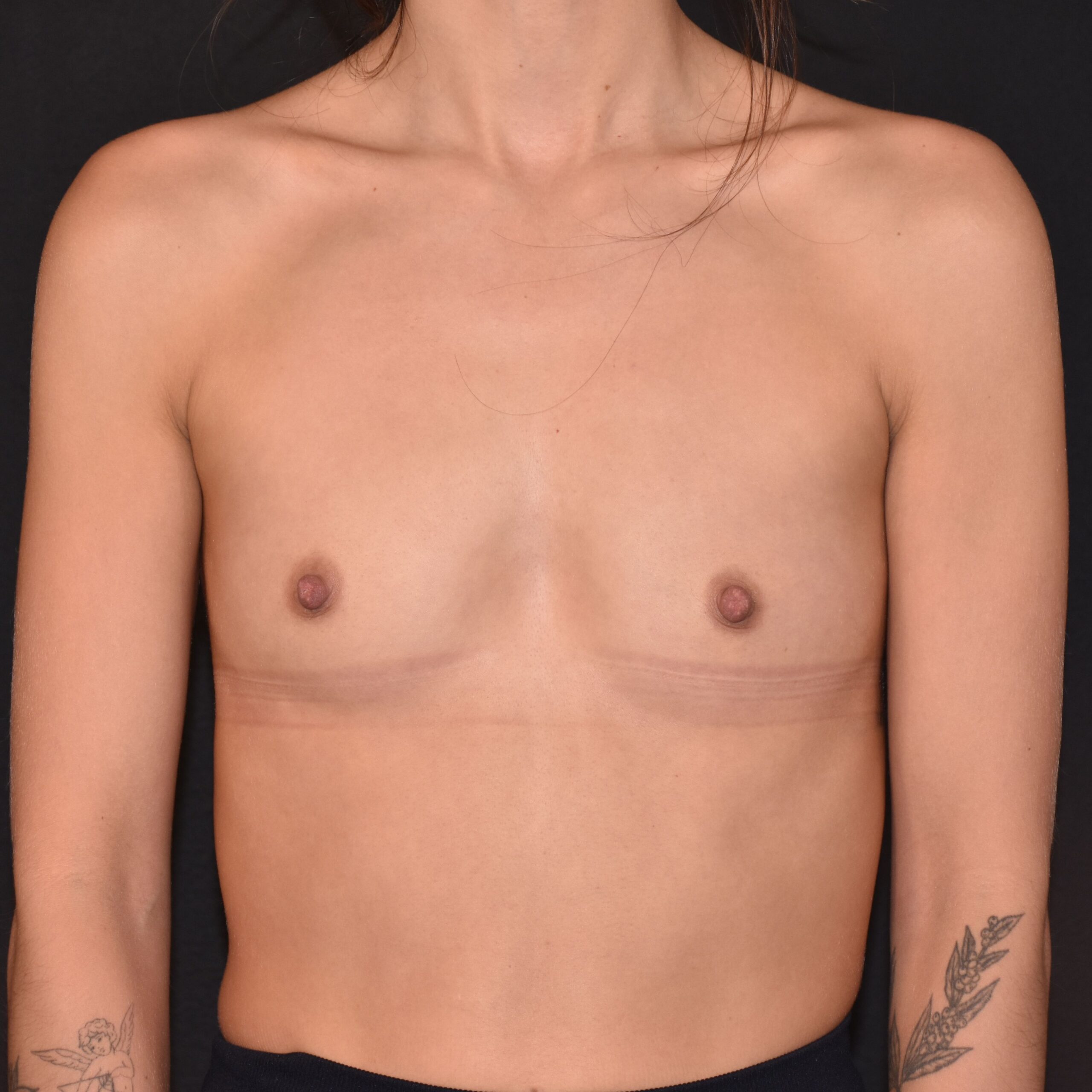 Case--9140 | Before Breast Augmentation