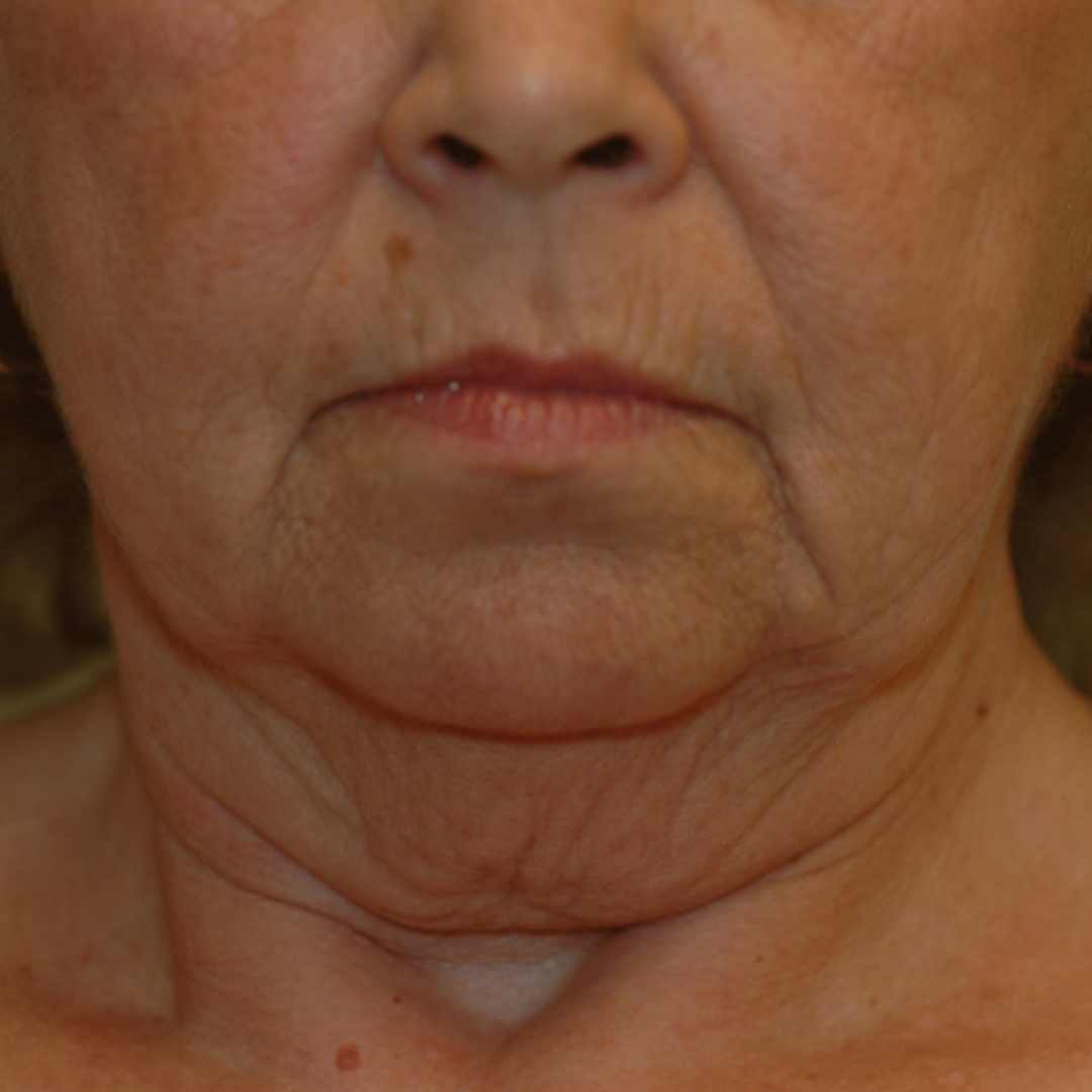 Case--9570 | Before Facelift and Neck Lift