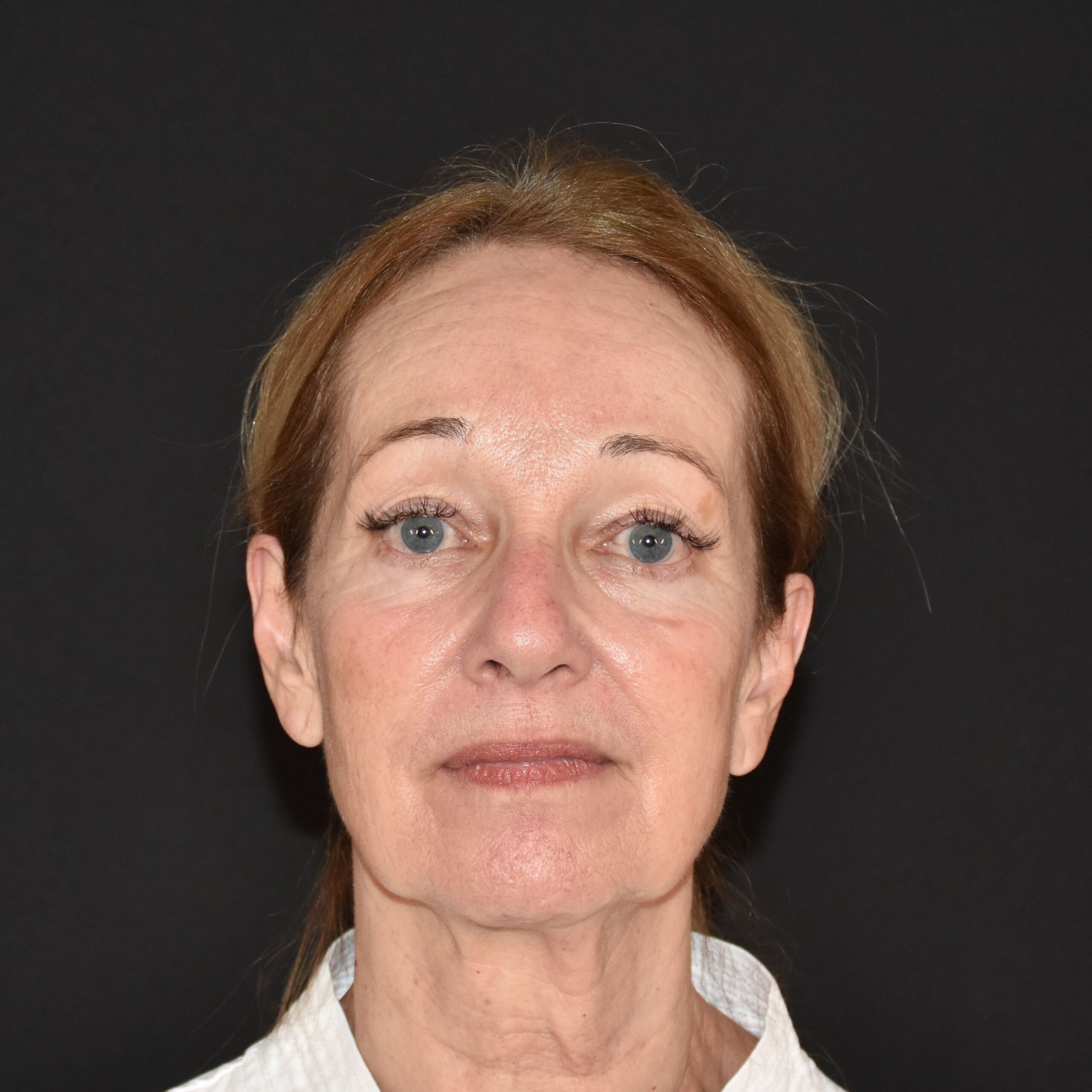 Case--3488 | Before Upper Blepharoplasty