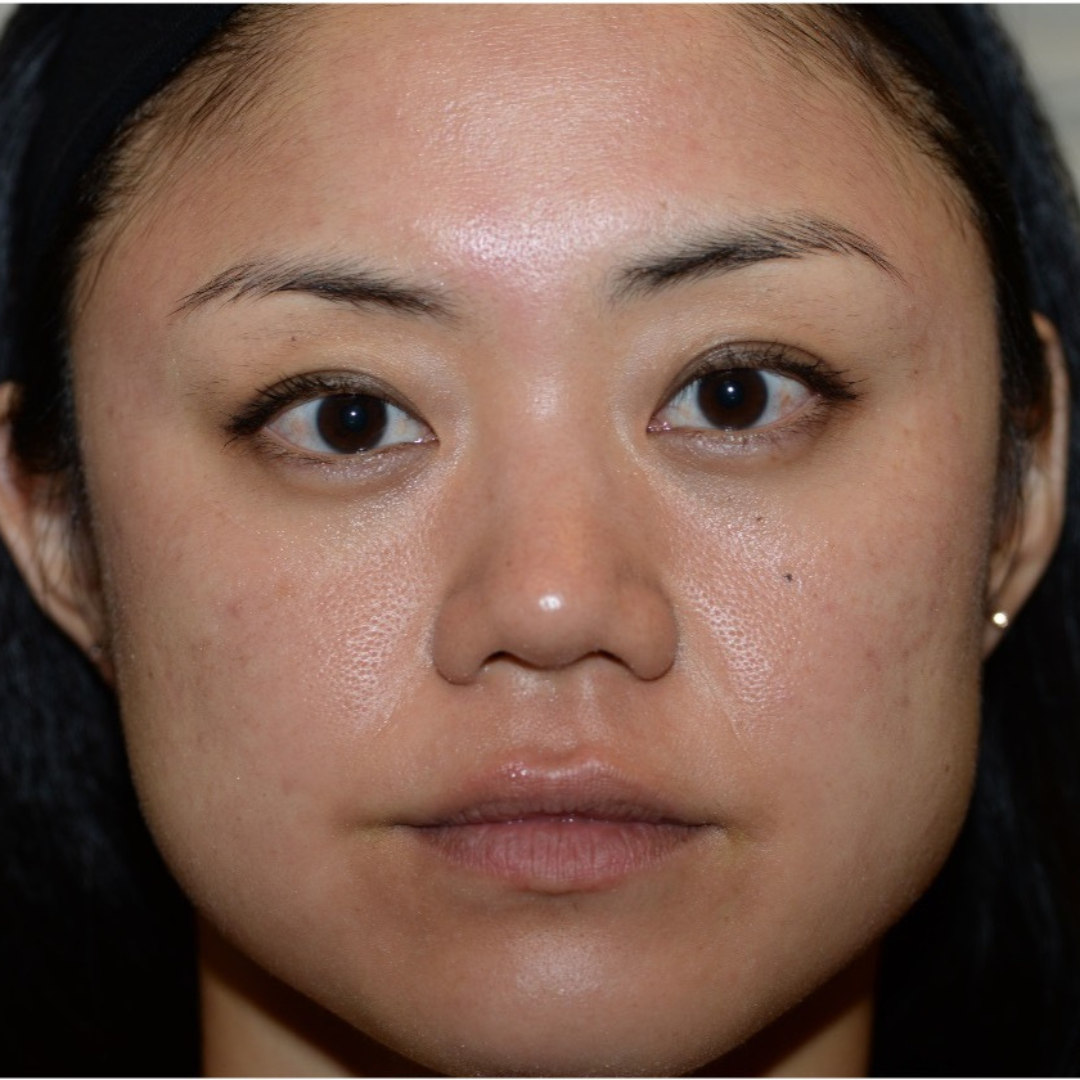 Case--6069 | Before IPL & Laser Treatments 2