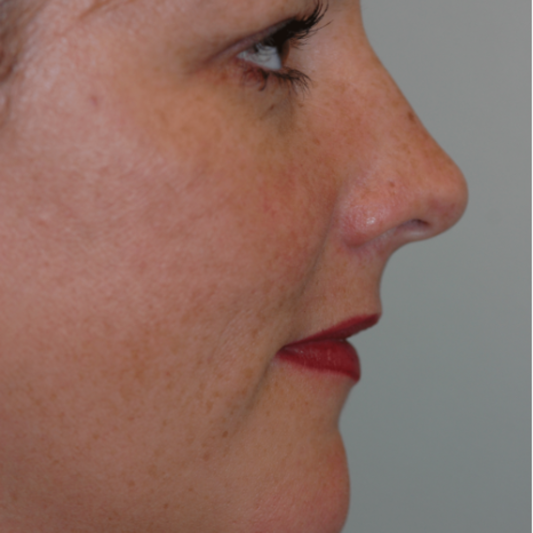 Case--9236 | Before Medspa