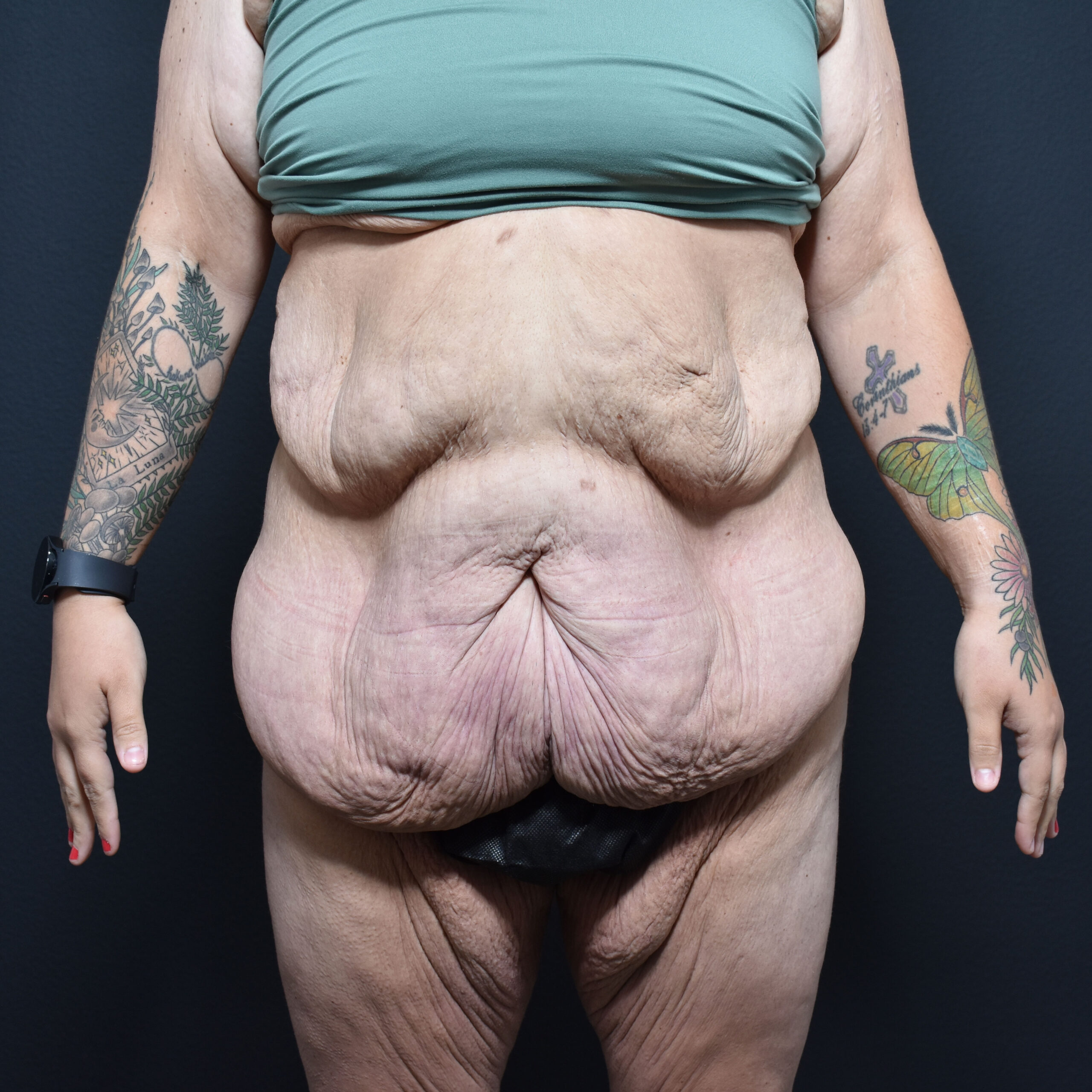 Case--8152 | Before Massive Weight Loss