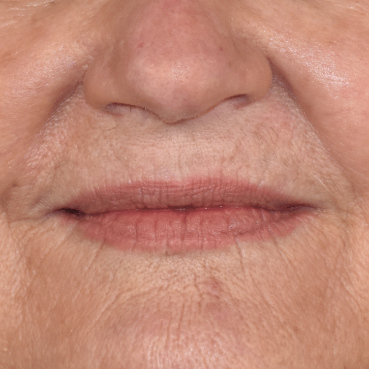 Case--4199 | Before Facial Fillers