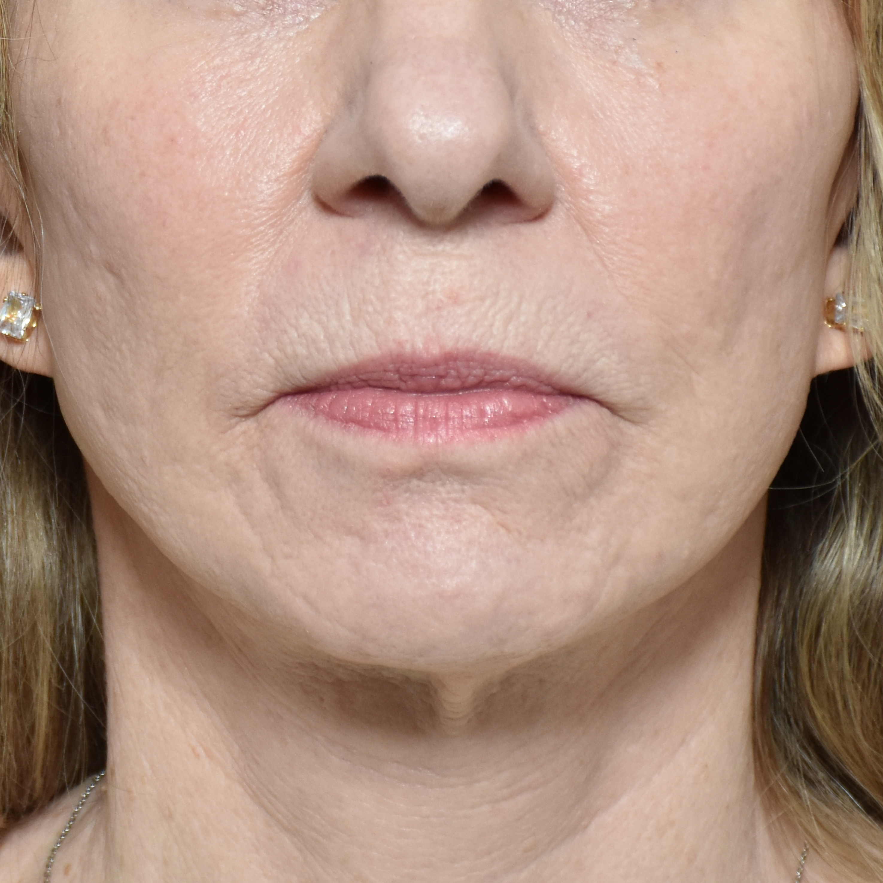 Case--5516 | Before Lip Lift