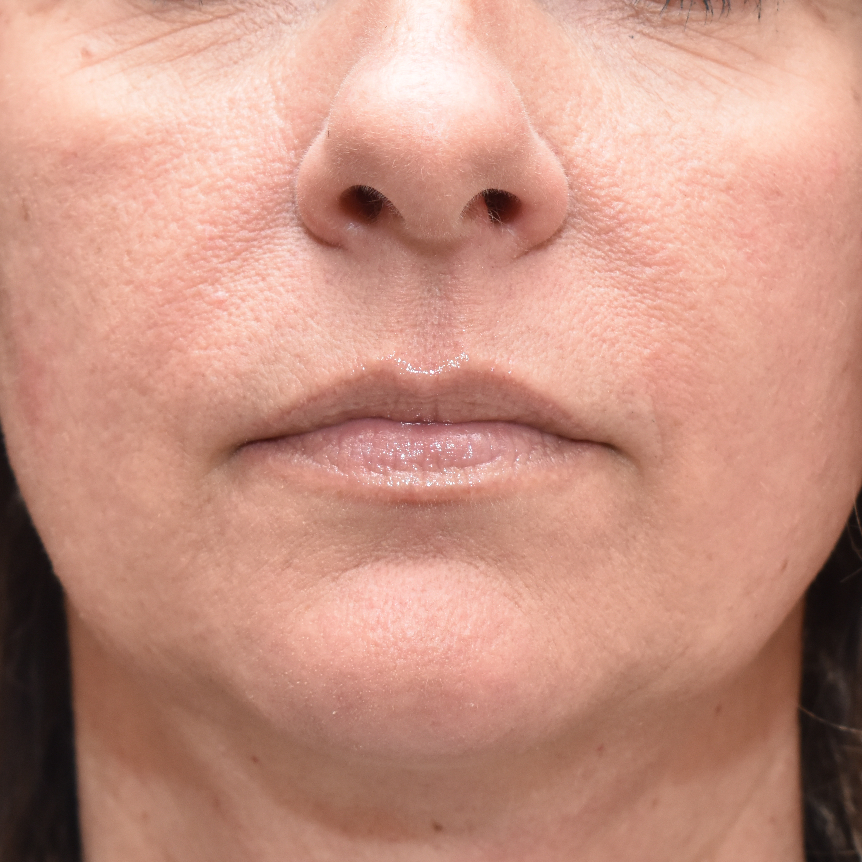 Case--4475 | Before Facial Fillers