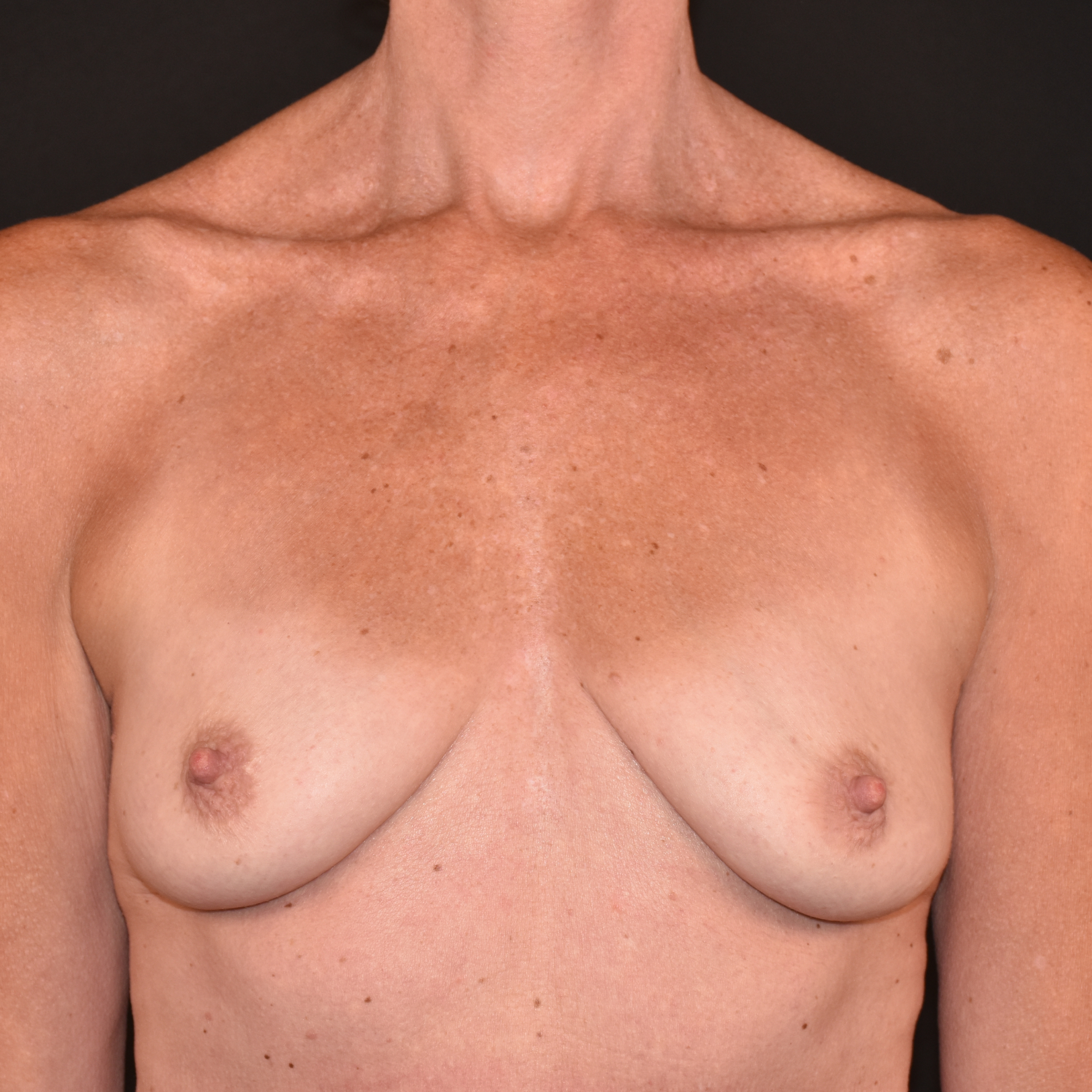 Case--6257 | Before Breast