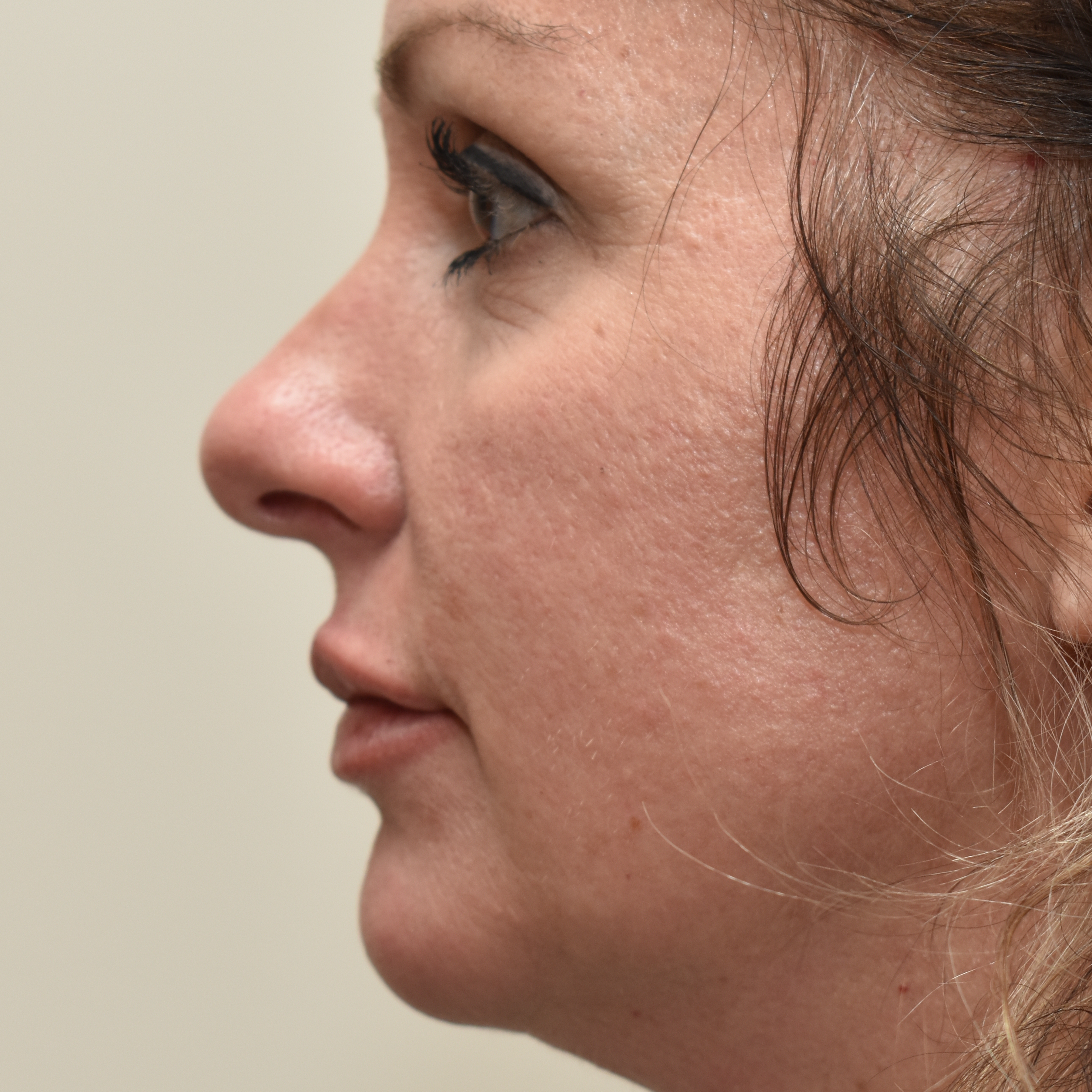 Case--4475 | After Facial Fillers 2