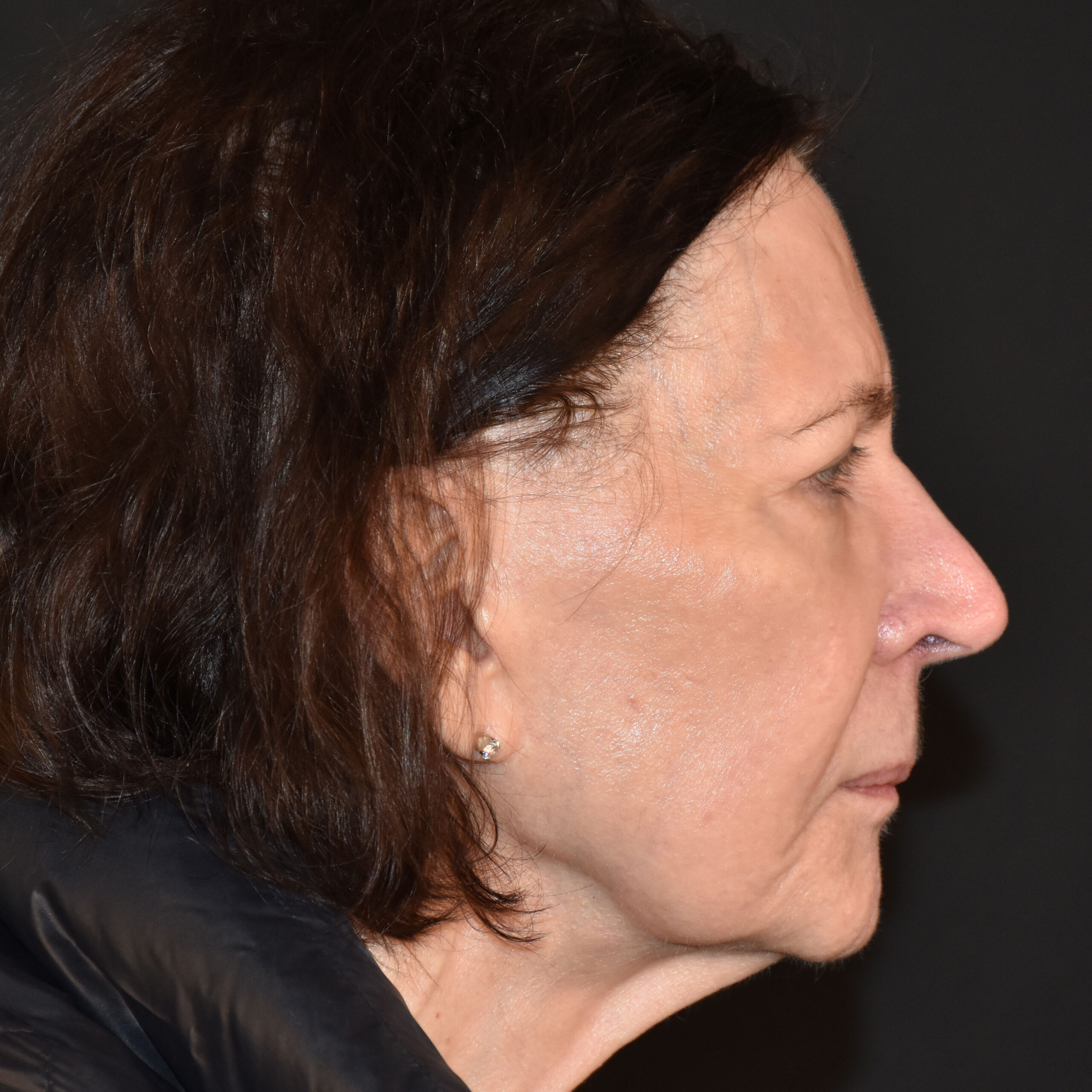 Case--1382 | After Facial Fillers 2