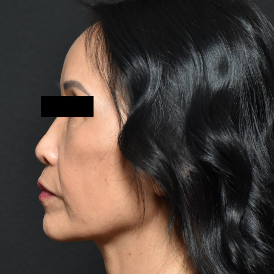 Case--7237 | After Facials and Peels 3