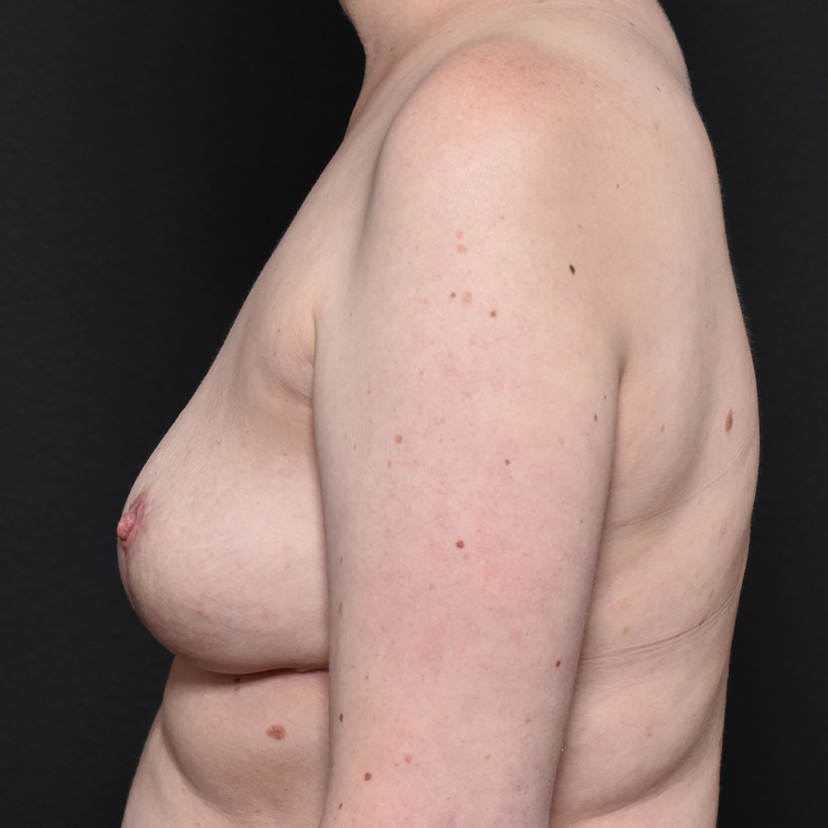 Case--4816 | After Breast Lift 3