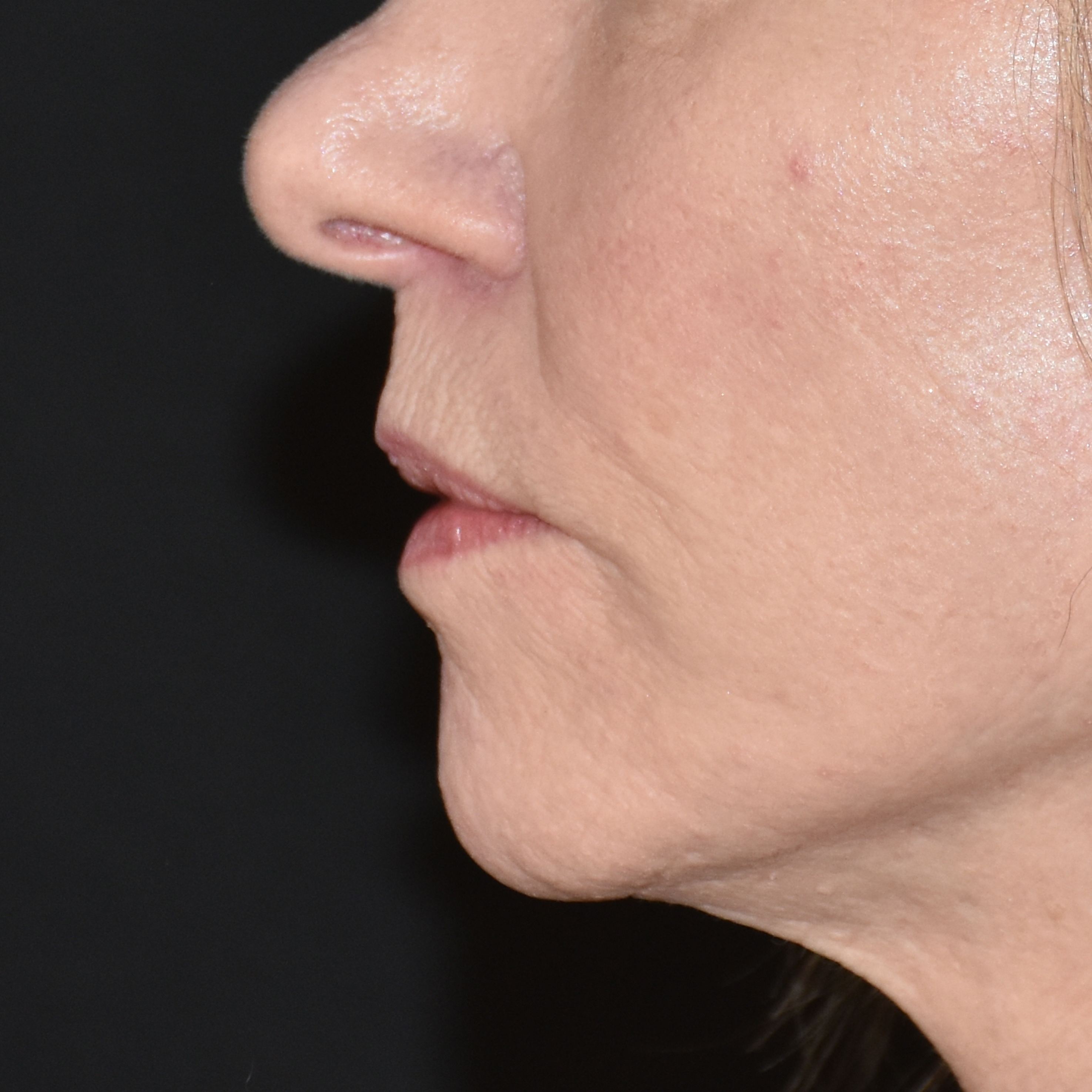 Case--5516 | After Lip Lift 3