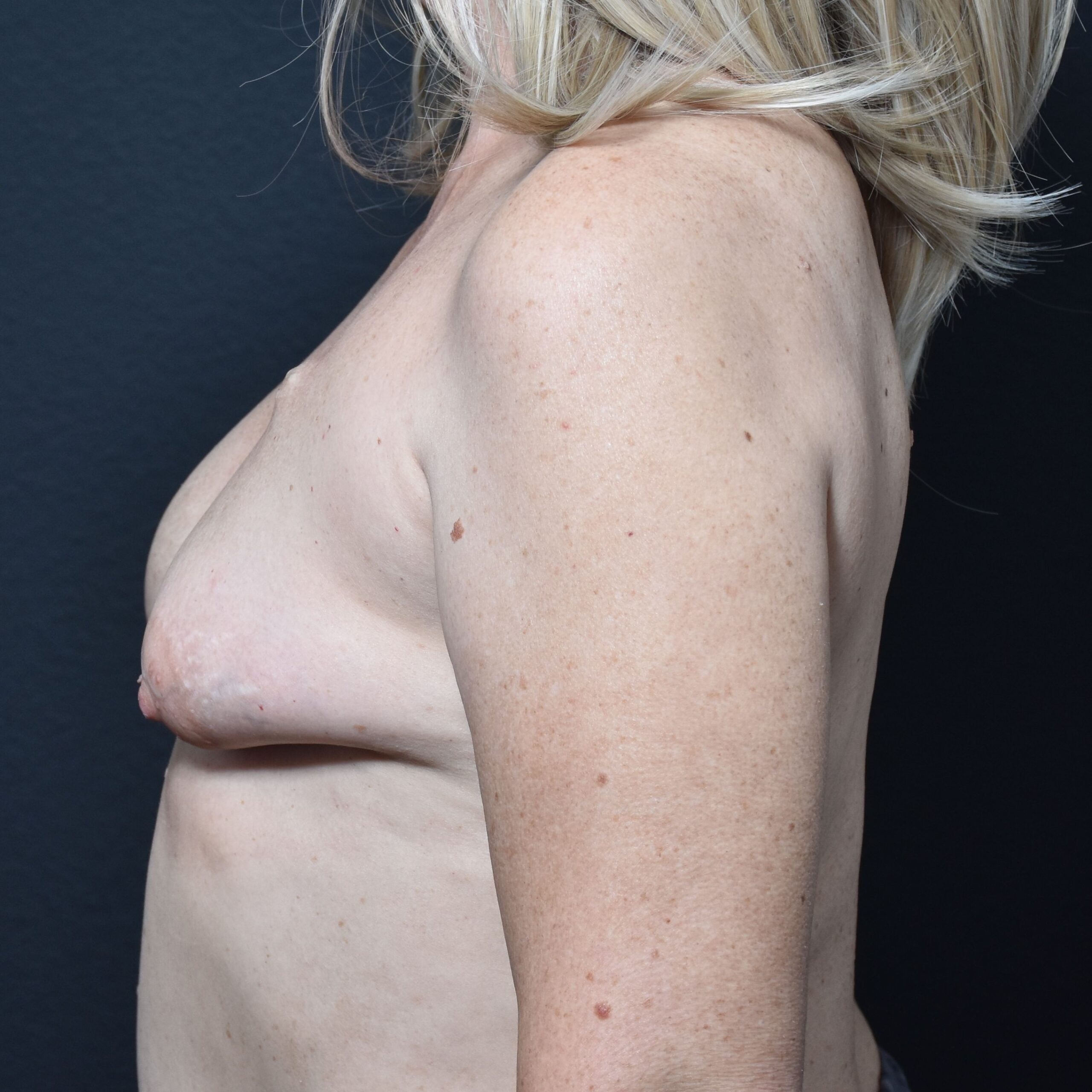 Case--2670 | Before Breast Reconstruction 2